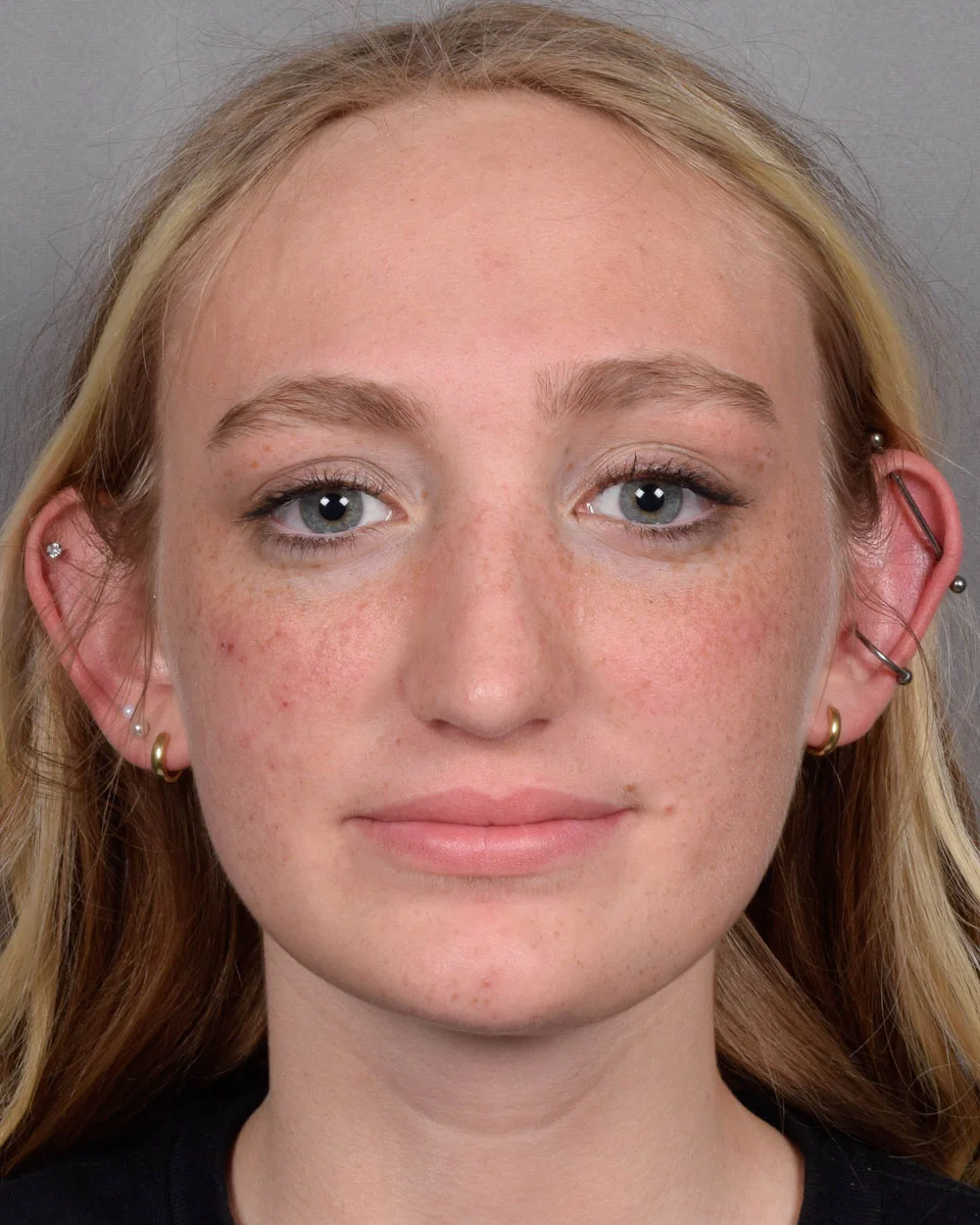 After Rhinoplasty Profile Smiling - Vegas Facial Plastics, Mehdi Sina, MD