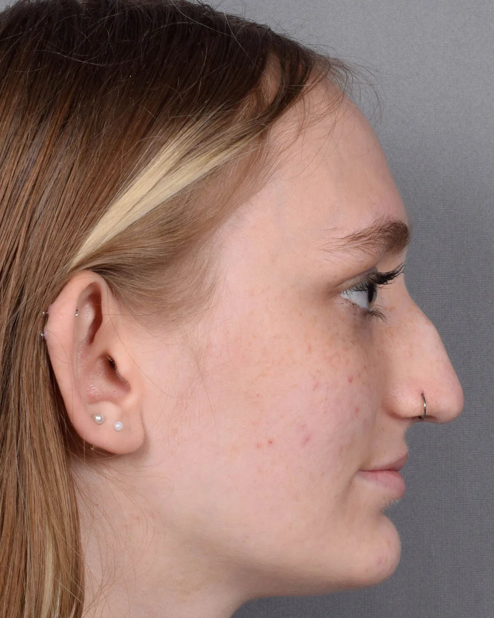 Before Rhinoplasty Profile - Vegas Facial Plastics, Mehdi Sina, MD