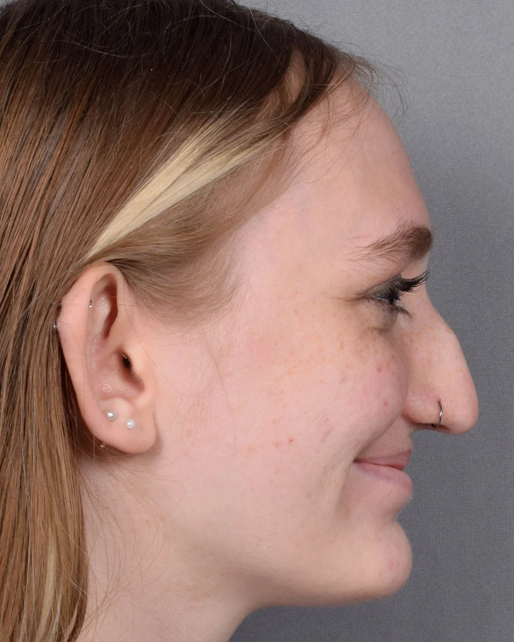 Before Rhinoplasty Profile Smiling - Vegas Facial Plastics, Mehdi Sina, MD