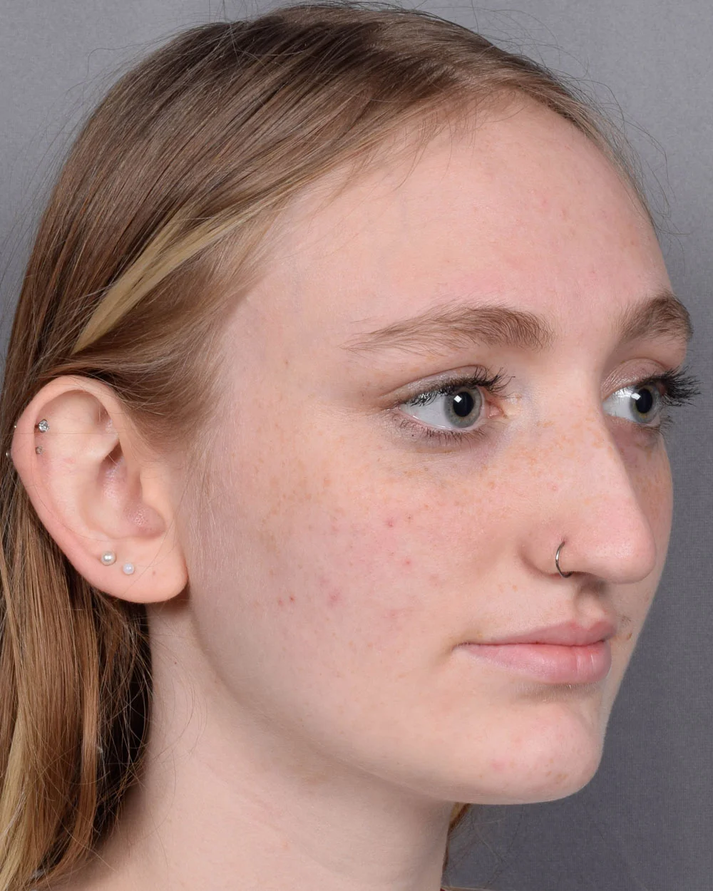 Before Rhinoplasty Oblique - Vegas Facial Plastics, Mehdi Sina, MD
