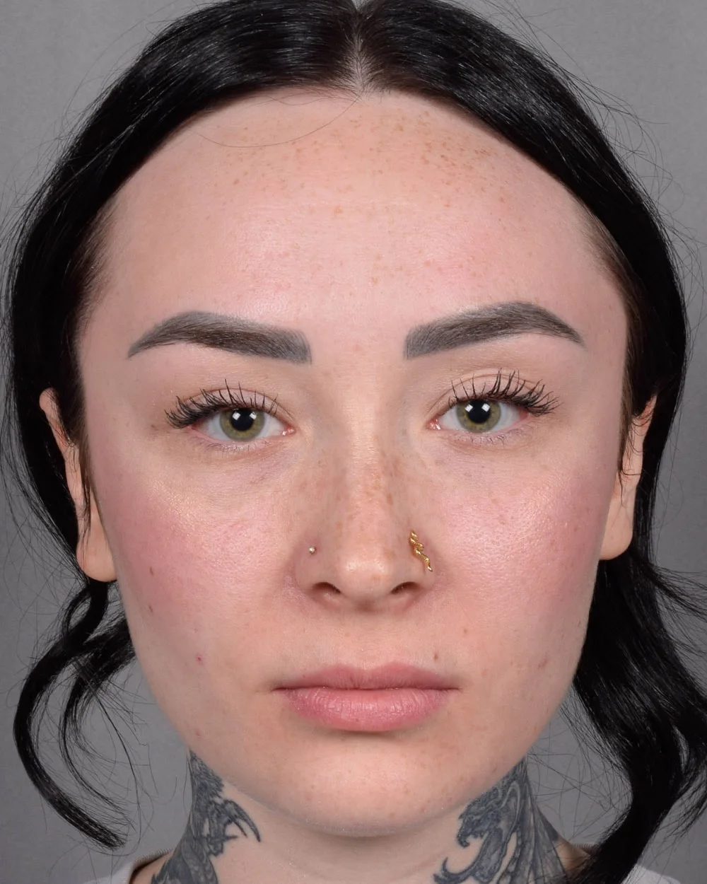 Before Lip Lift - Vegas Facial Plastics, Mehdi Sina, MD