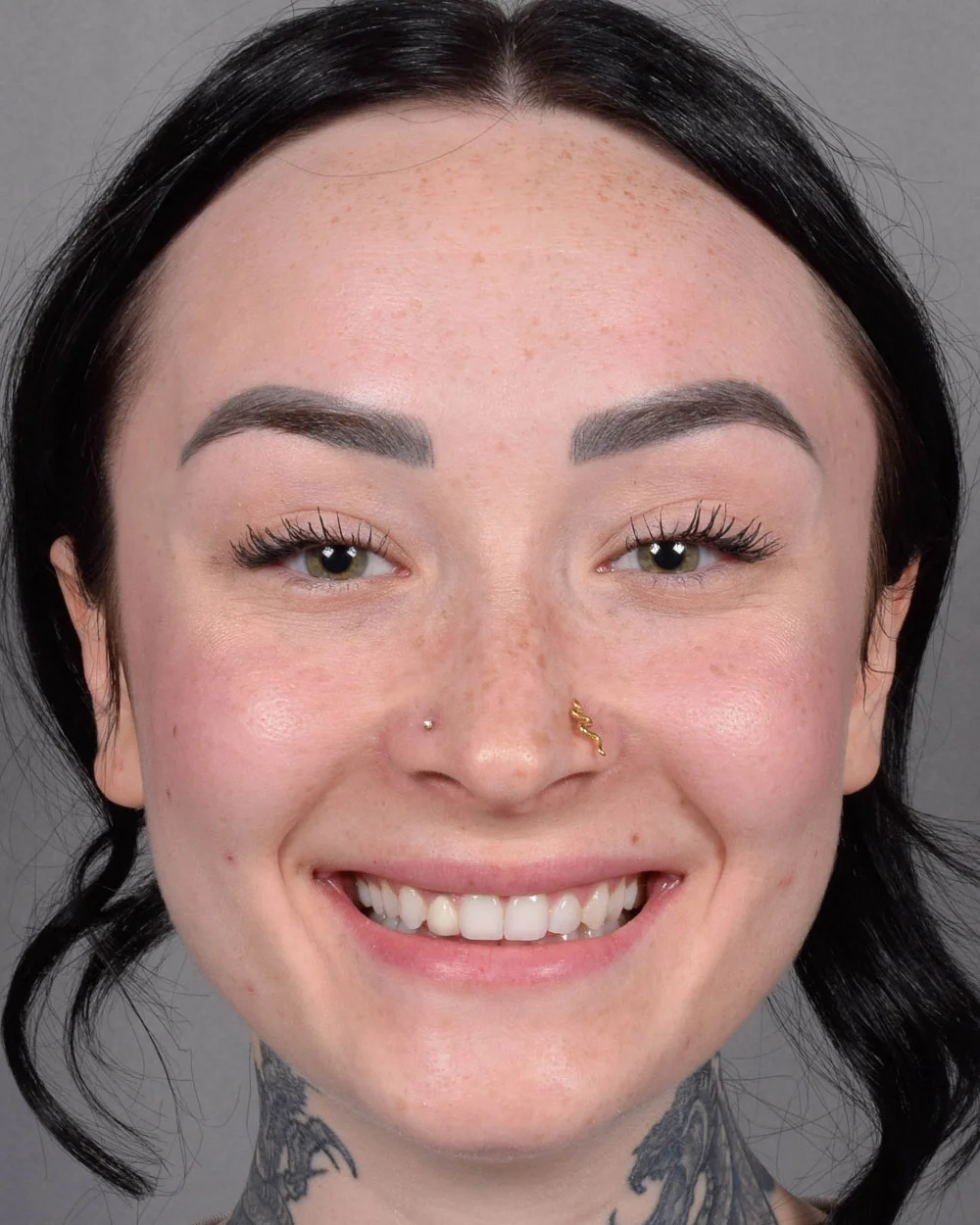 Before Lip Lift, Smiling - Vegas Facial Plastics, Mehdi Sina, MD