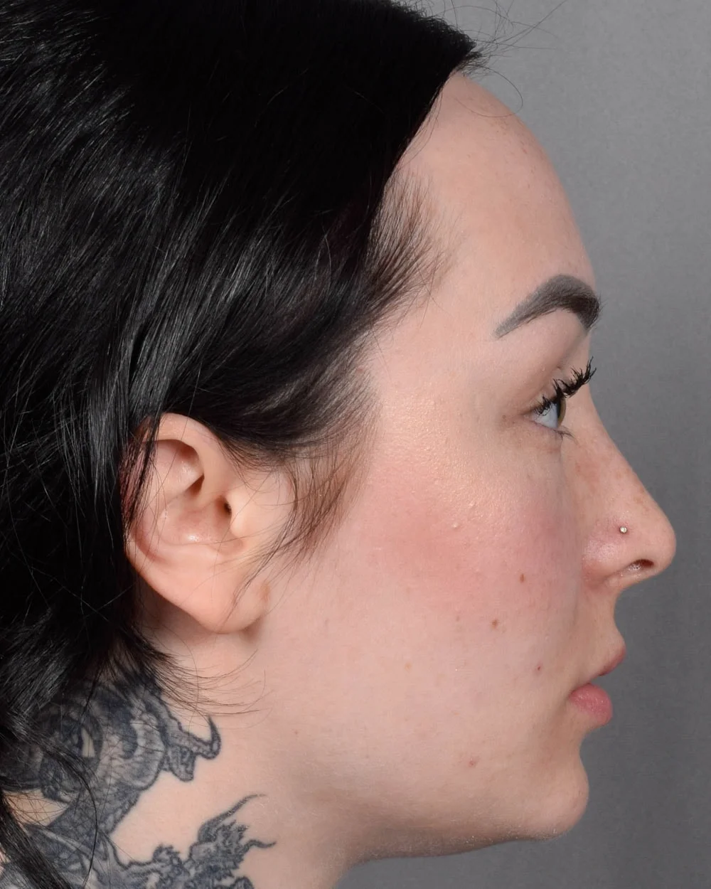 Before Lip Lift, Profile - Vegas Facial Plastics, Mehdi Sina, MD