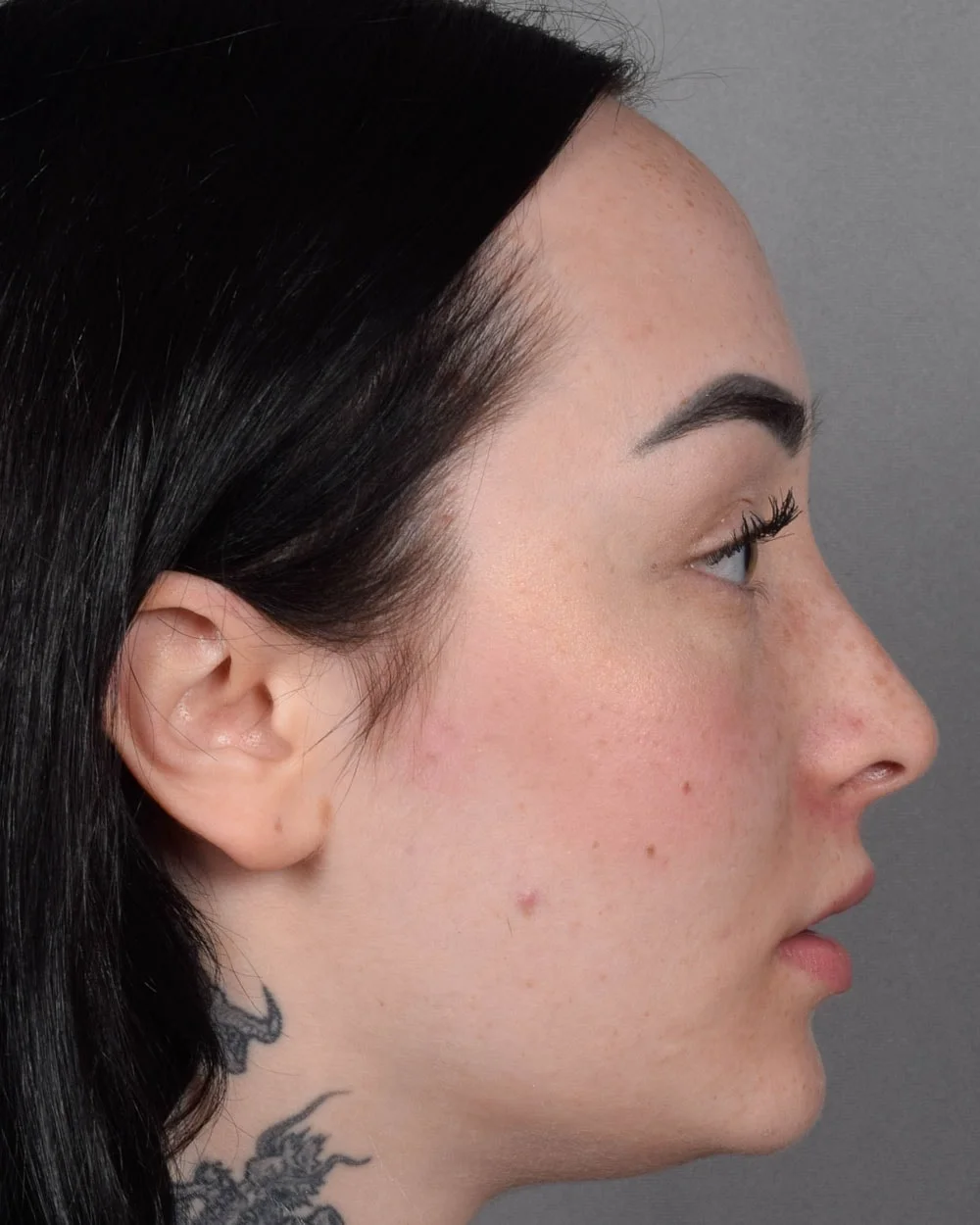 After Lip Lift, Profile - Vegas Facial Plastics, Mehdi Sina, MD