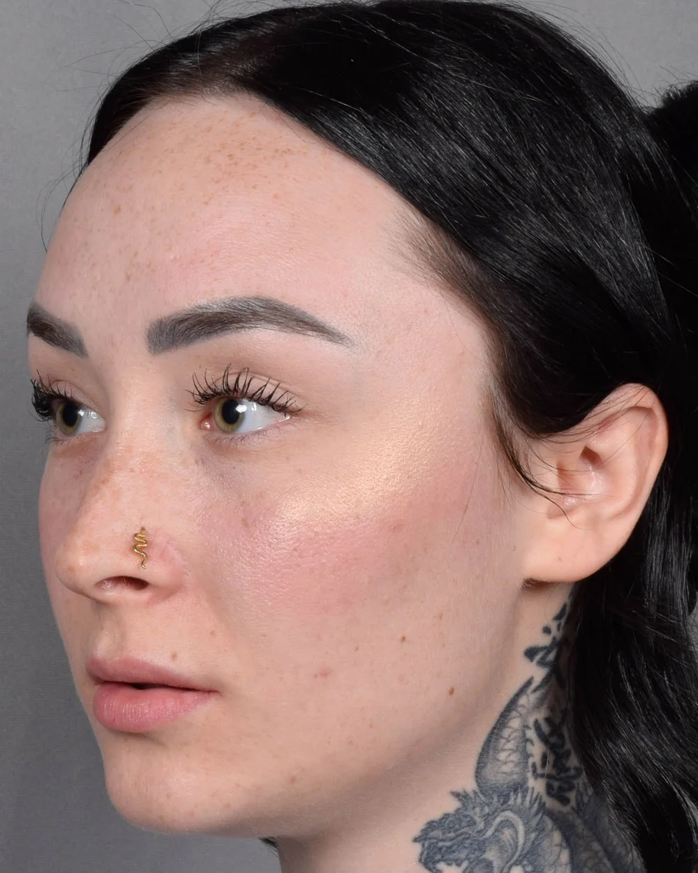 Before Lip Lift, Oblique - Vegas Facial Plastics, Mehdi Sina, MD