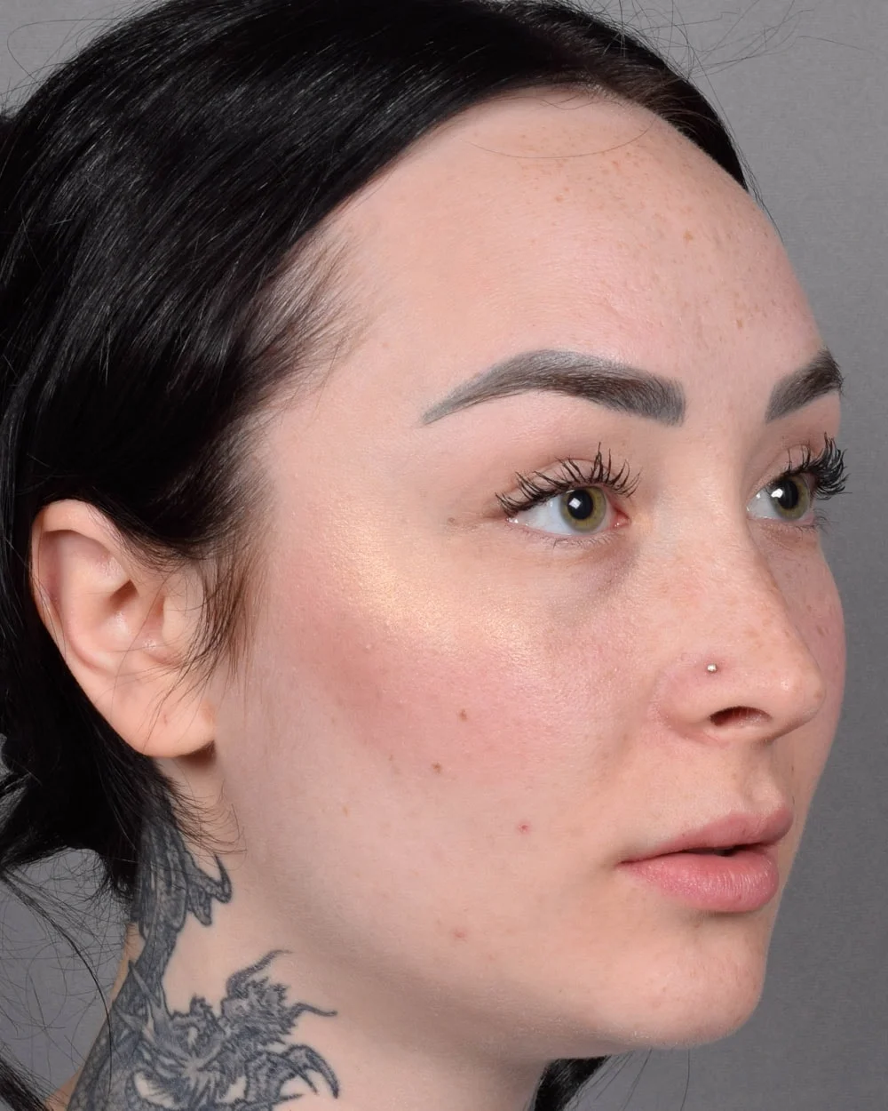 Before Lip Lift, Oblique - Vegas Facial Plastics, Mehdi Sina, MD