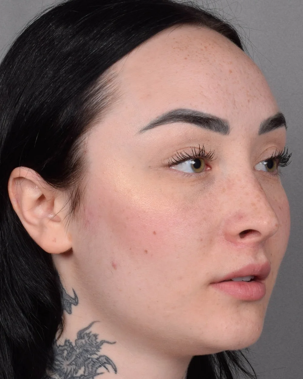 After Lip Lift, Oblique - Vegas Facial Plastics, Mehdi Sina, MD