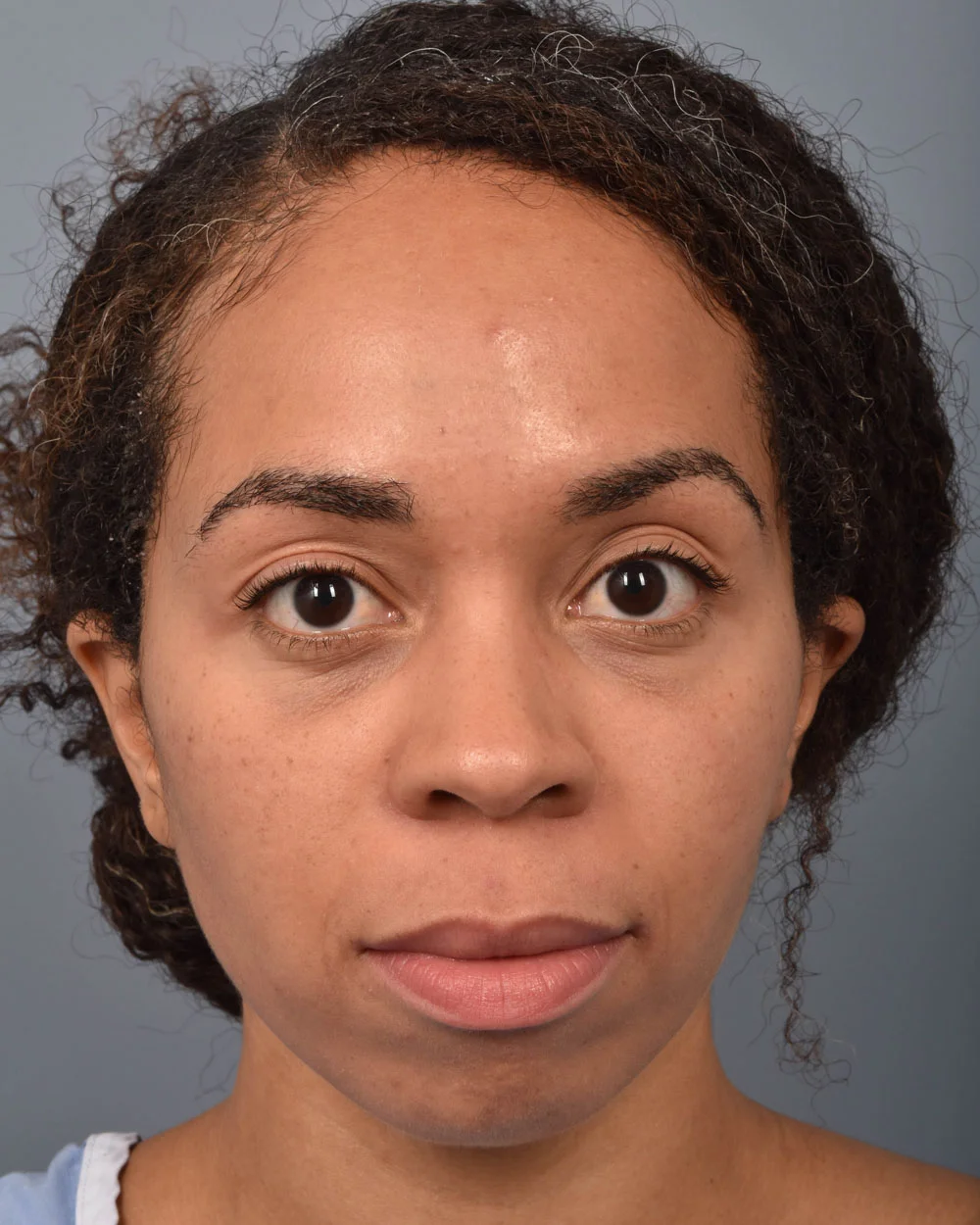 Before Lower Blepharoplasty - Vegas Facial Plastics, Mehdi Sina, MD