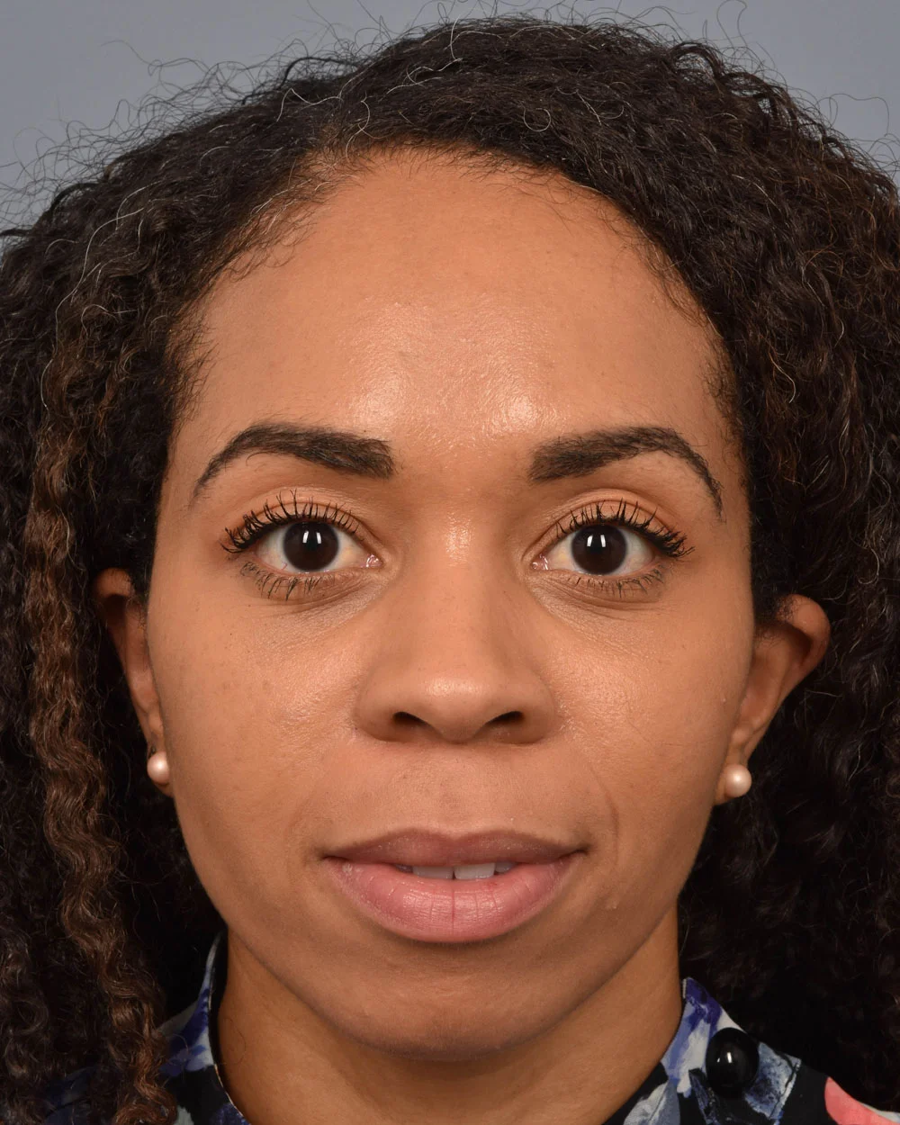 After Lower Blepharoplasty - Vegas Facial Plastics, Mehdi Sina, MD