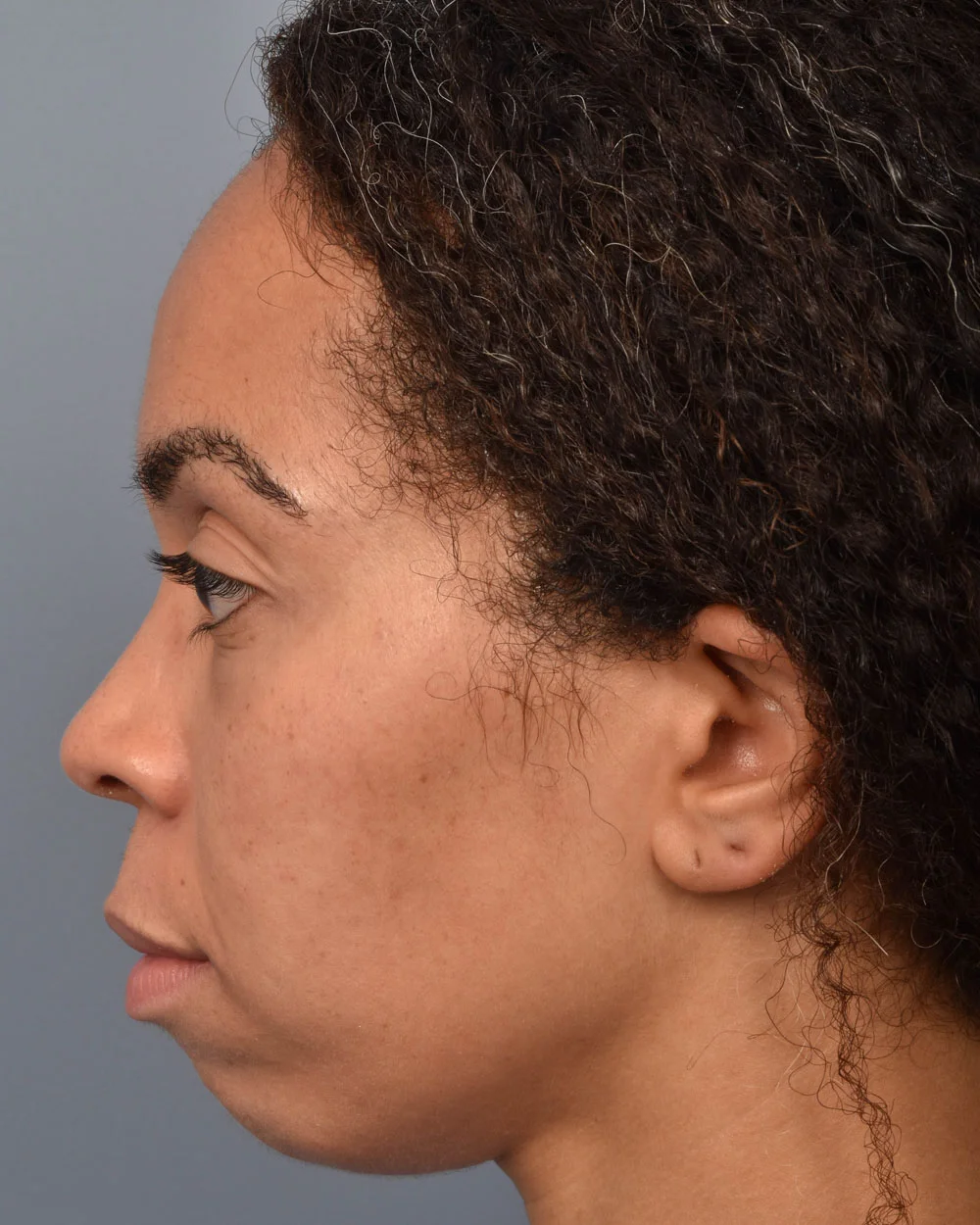 Before Lower Blepharoplasty Profile - Vegas Facial Plastics, Mehdi Sina, MD