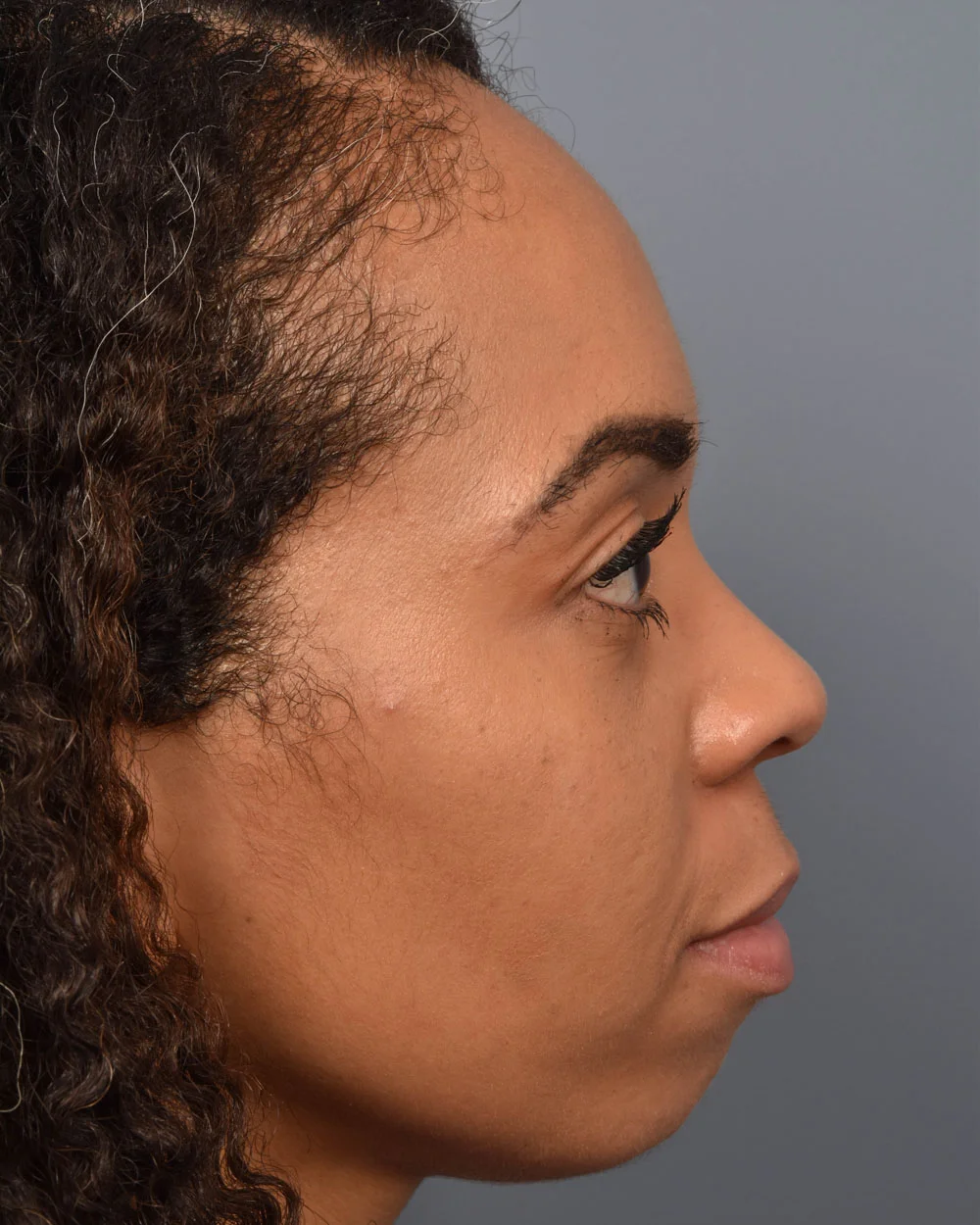 After Lower Blepharoplasty Profile - Vegas Facial Plastics, Mehdi Sina, MD