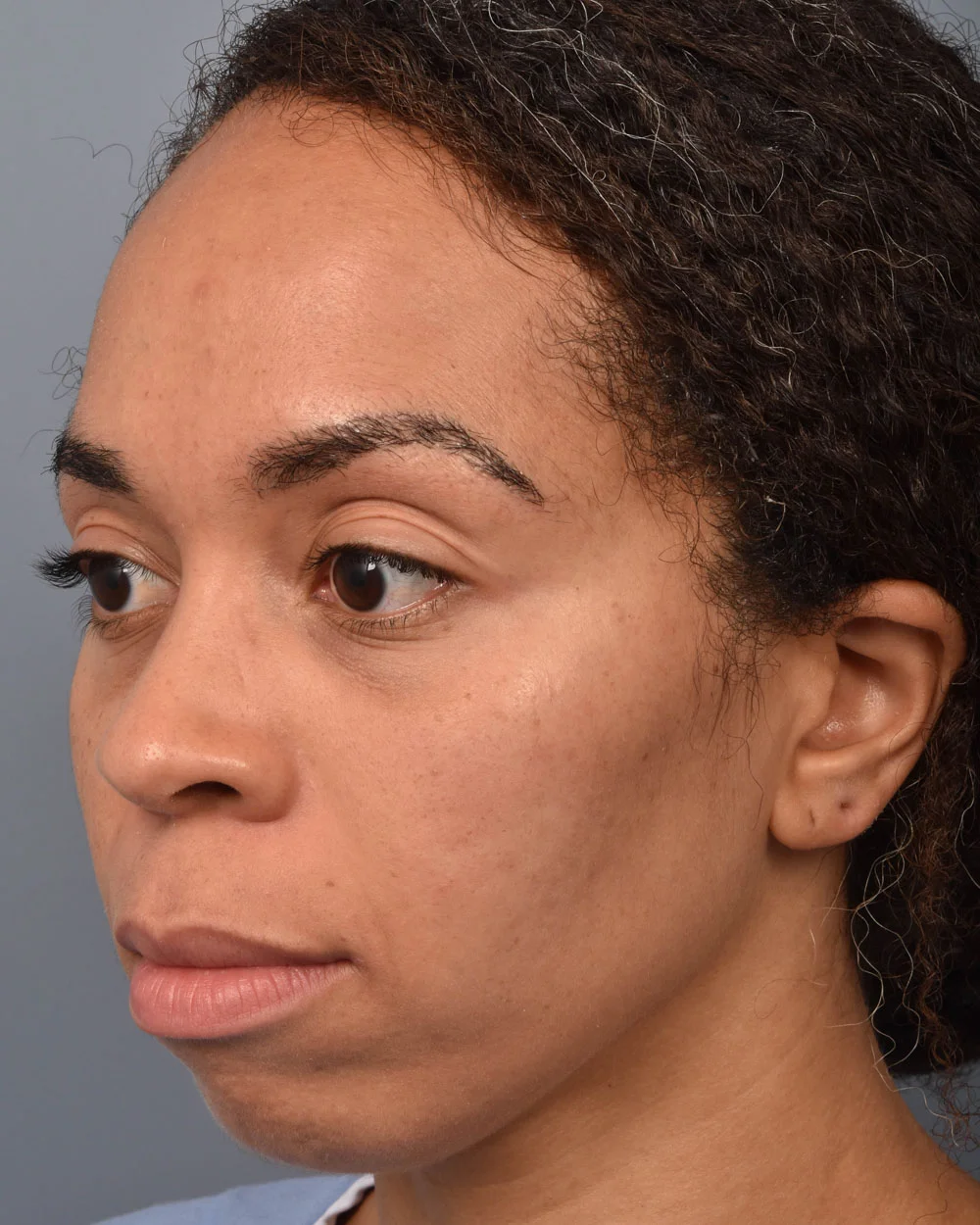 Before Lower Blepharoplasty Oblique - Vegas Facial Plastics, Mehdi Sina, MD