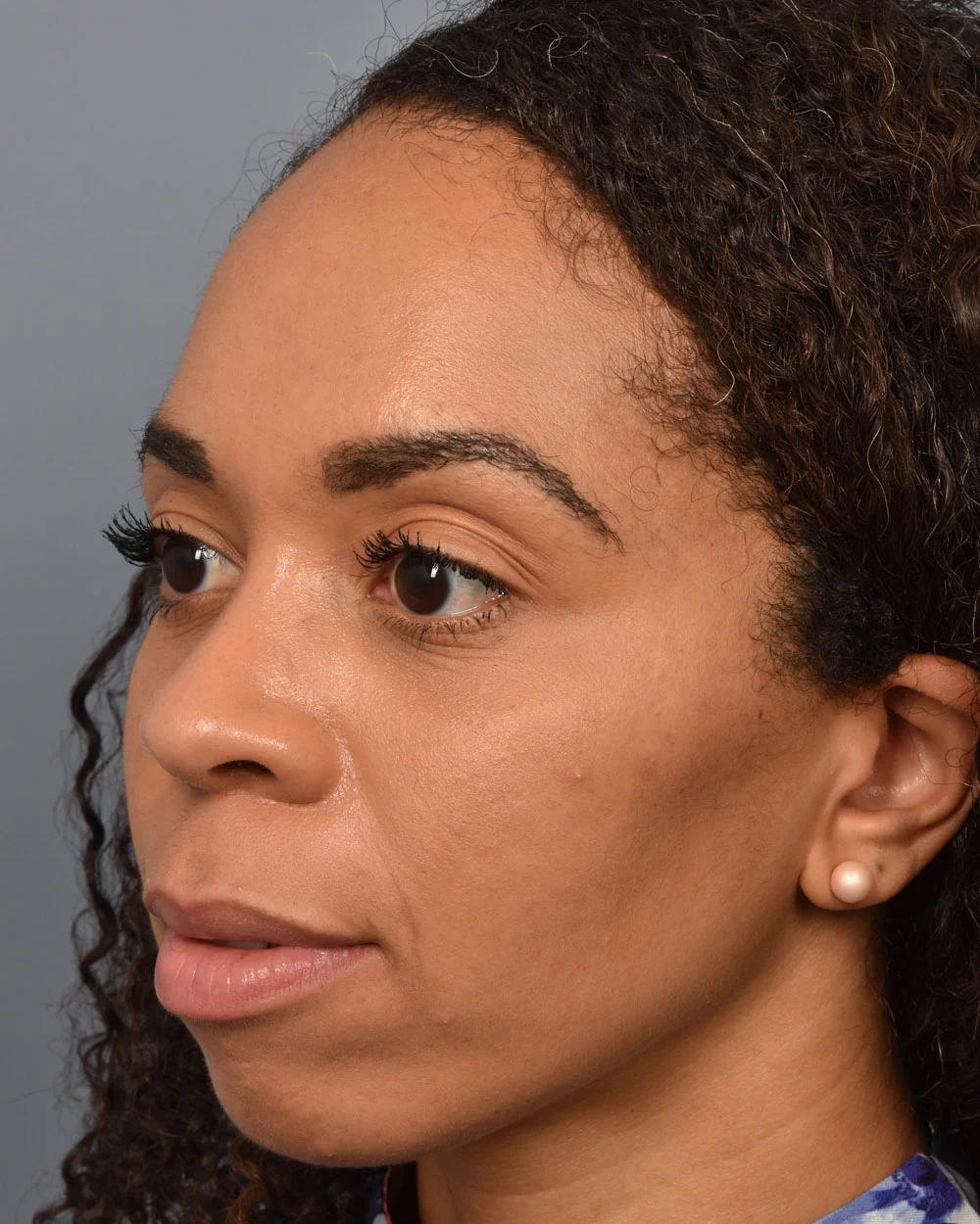 After Lower Blepharoplasty Oblique - Vegas Facial Plastics, Mehdi Sina, MD