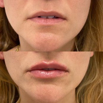 Before and after - lip filler. Dr. Sina actual patient