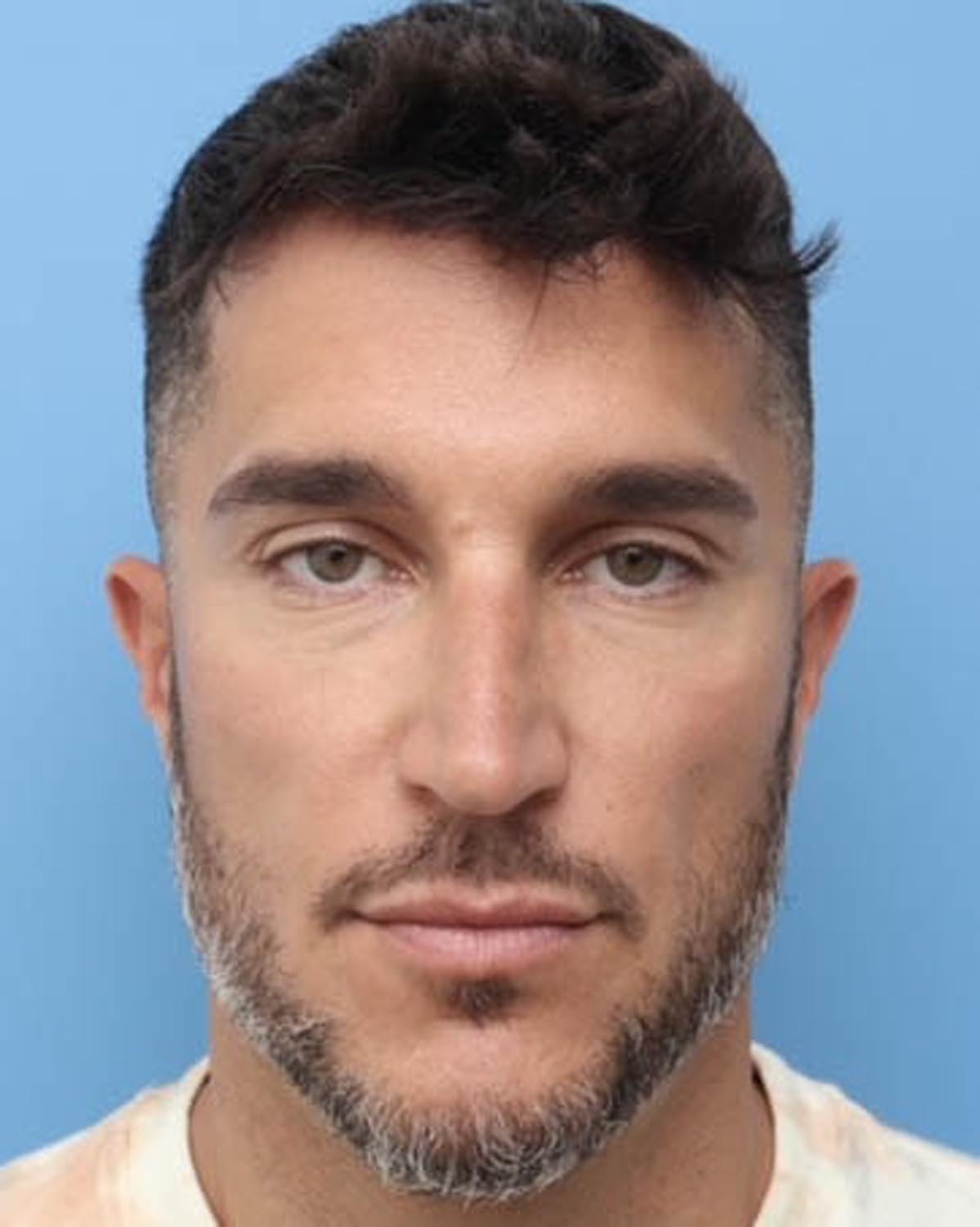 Before Male Rhinoplasty - Vegas Facial Plastics, Mehdi Sina, MD