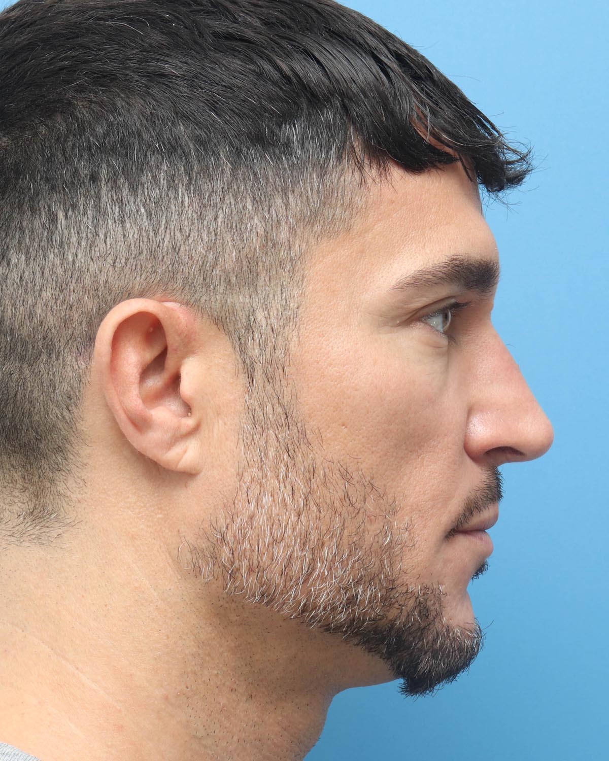 After Male Rhinoplasty Profile - Vegas Facial Plastics, Mehdi Sina, MD