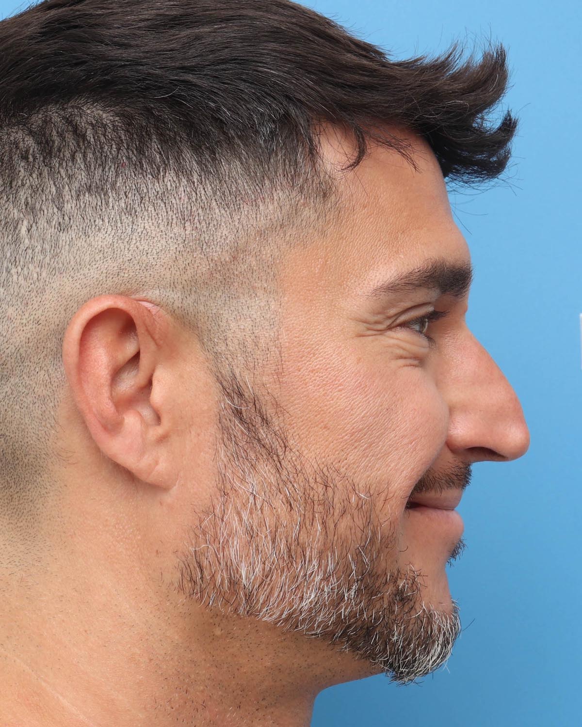 Before Male Rhinoplasty Profile Smiling - Vegas Facial Plastics, Mehdi Sina, MD