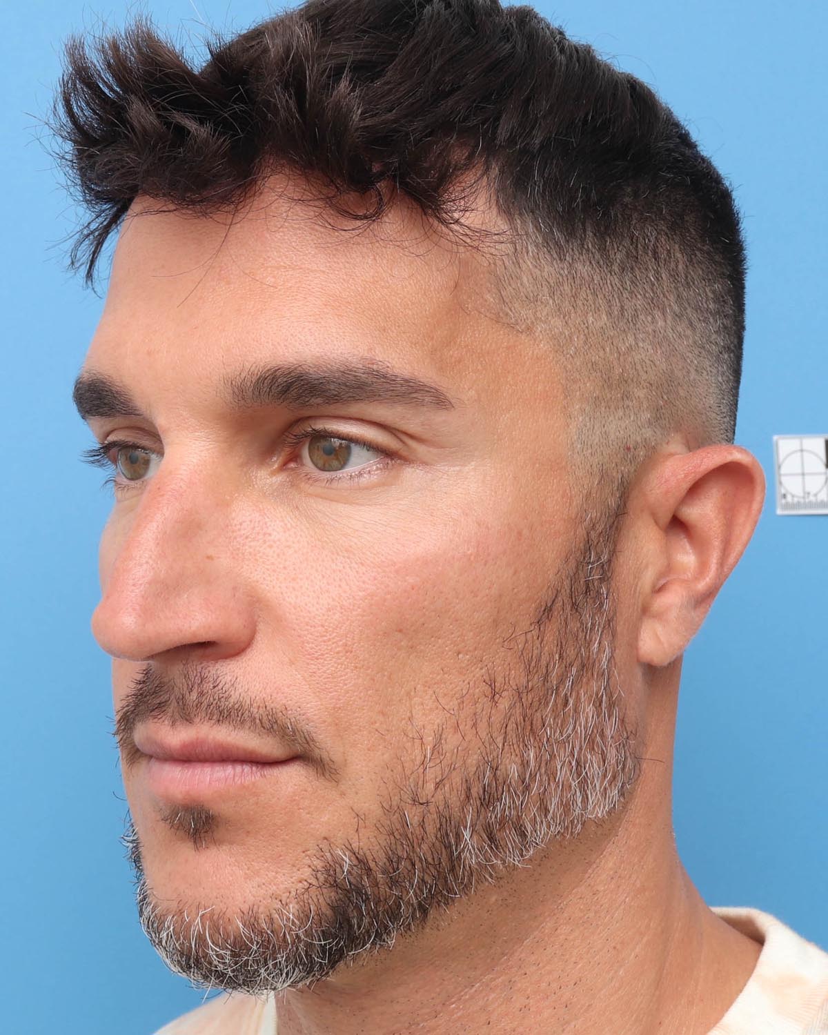 Before Male Rhinoplasty Oblique - Vegas Facial Plastics, Mehdi Sina, MD