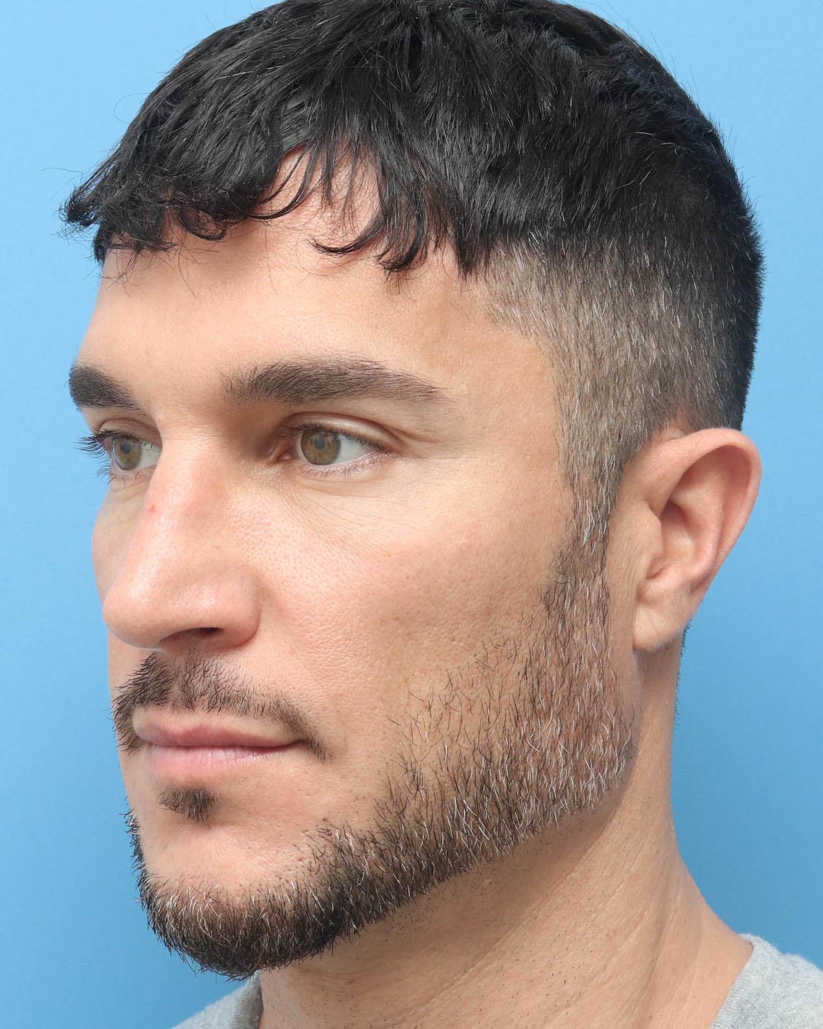 After Male Rhinoplasty Oblique - Vegas Facial Plastics, Mehdi Sina, MD