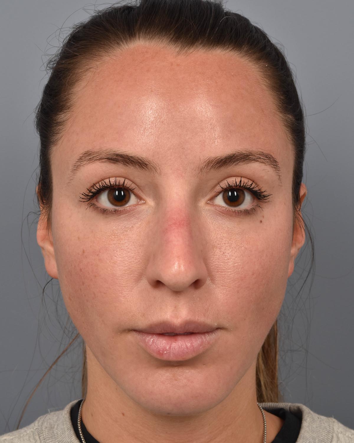 After Chin Implant & Submental Liposuction