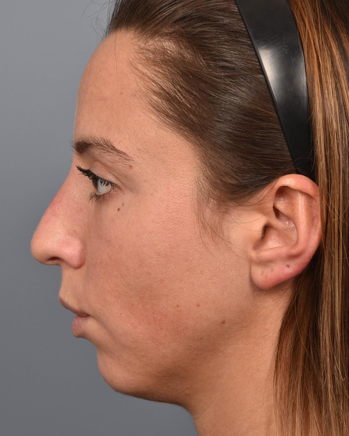 Before Chin Implant & Submental Liposuction Profile