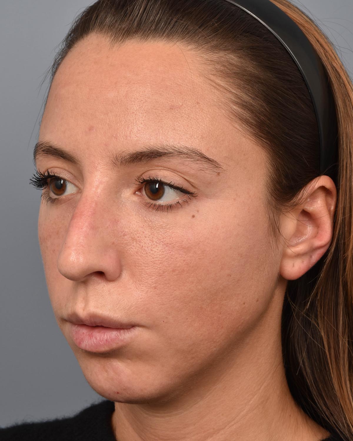 Before Chin Implant & Submental Liposuction Oblique