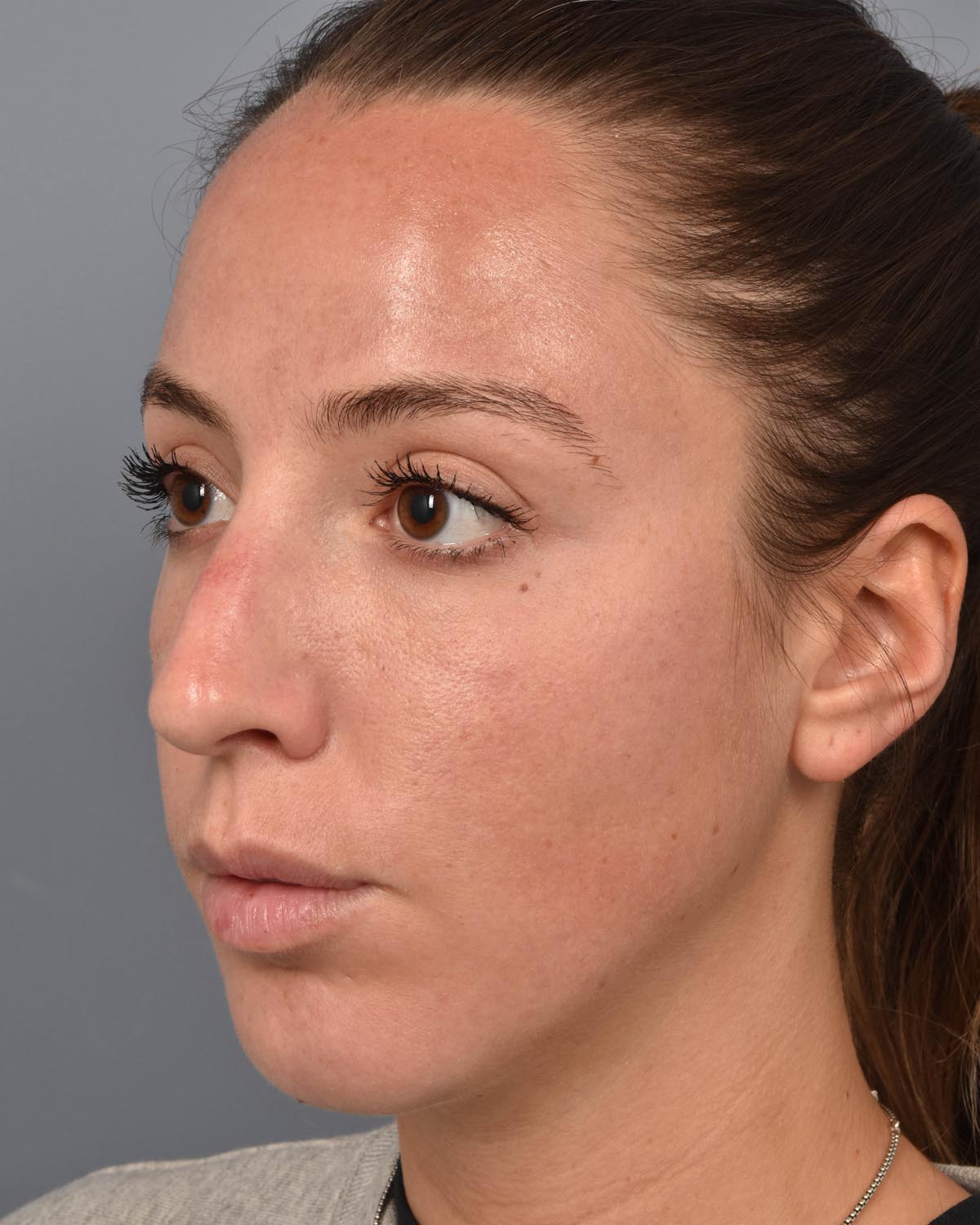 After Chin Implant & Submental Liposuction Oblique