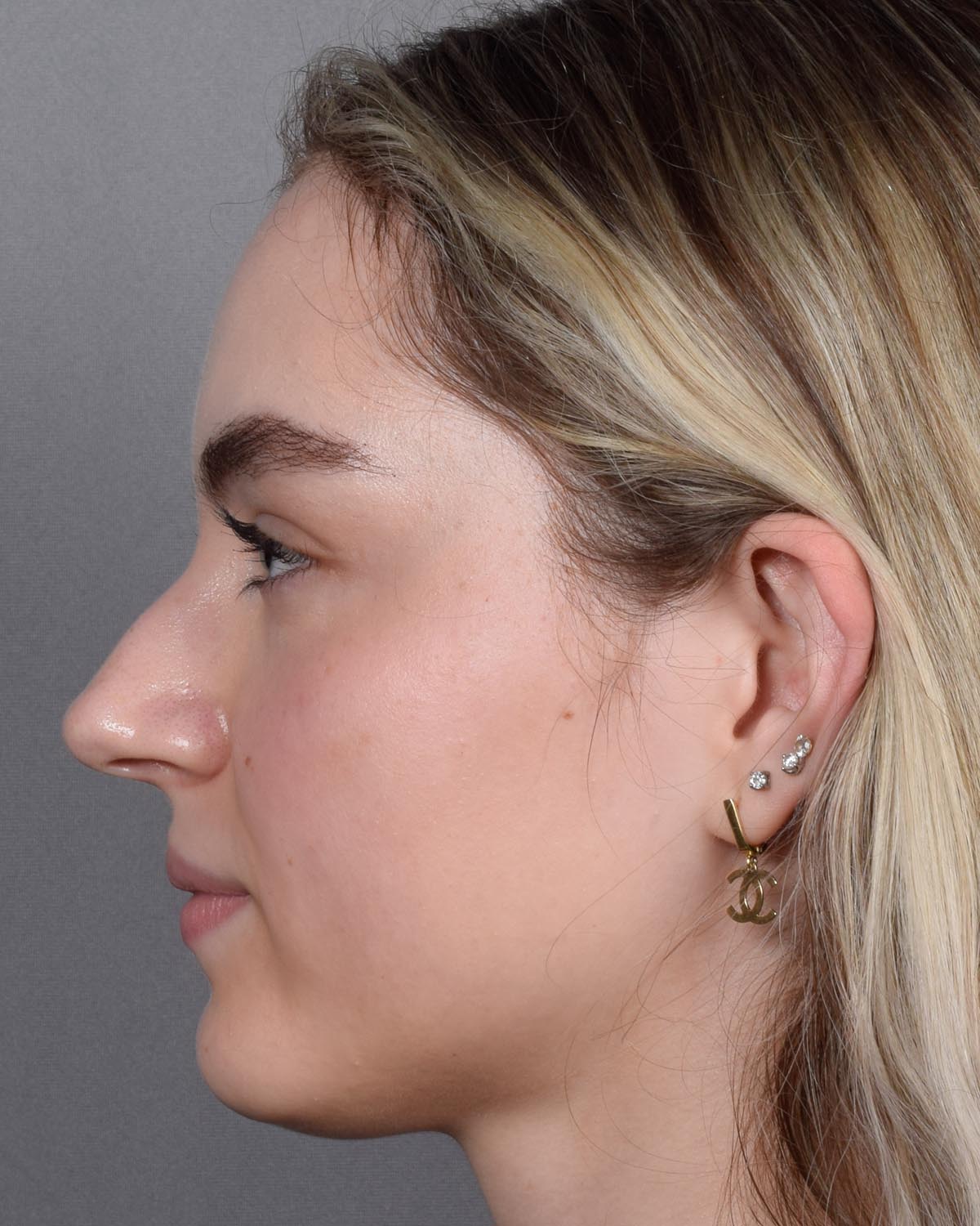 Before Functional Rhinoplasty Profile - Vegas Facial Plastics, Mehdi Sina, MD