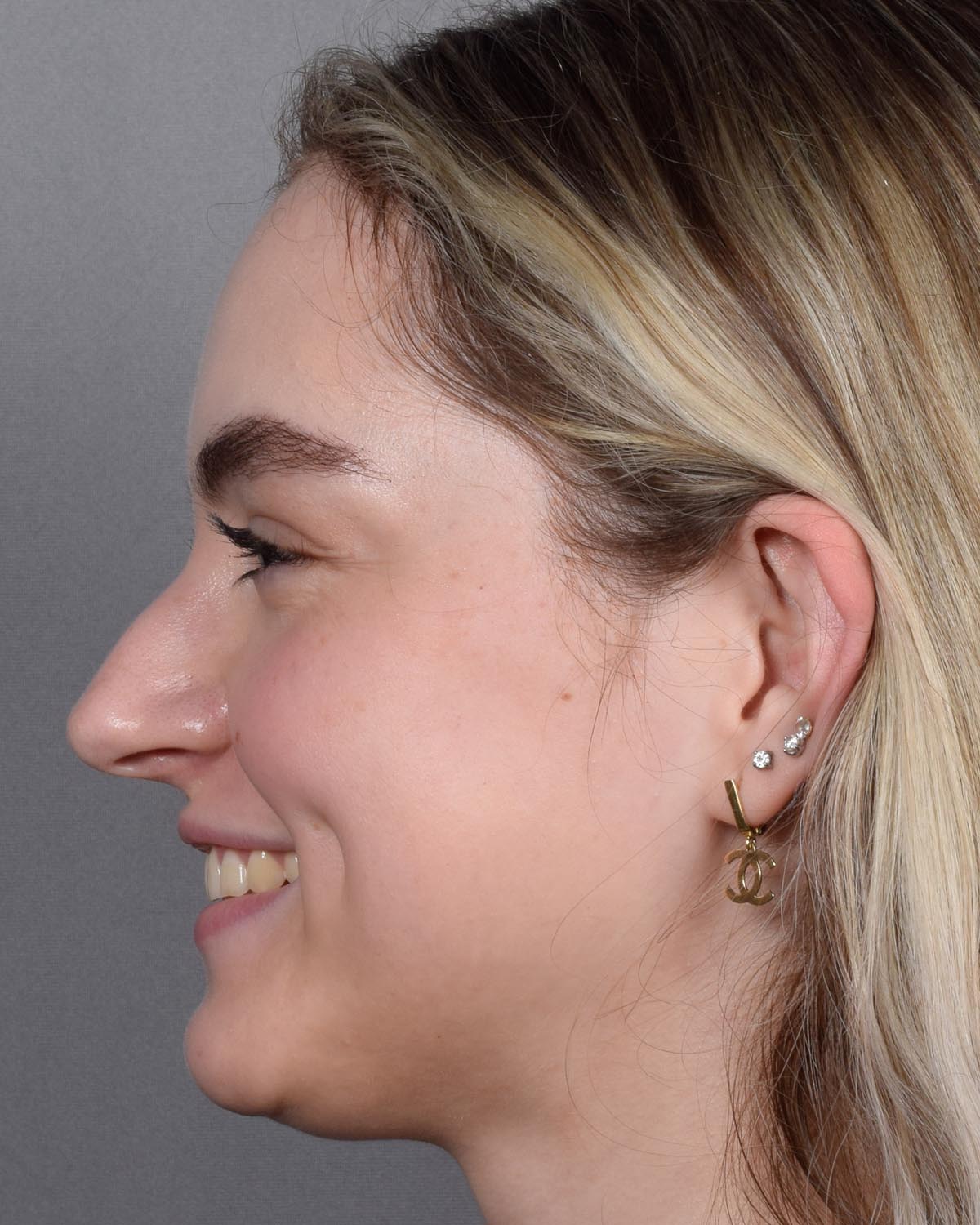 Before Functional Rhinoplasty Profile Smiling - Vegas Facial Plastics, Mehdi Sina, MD