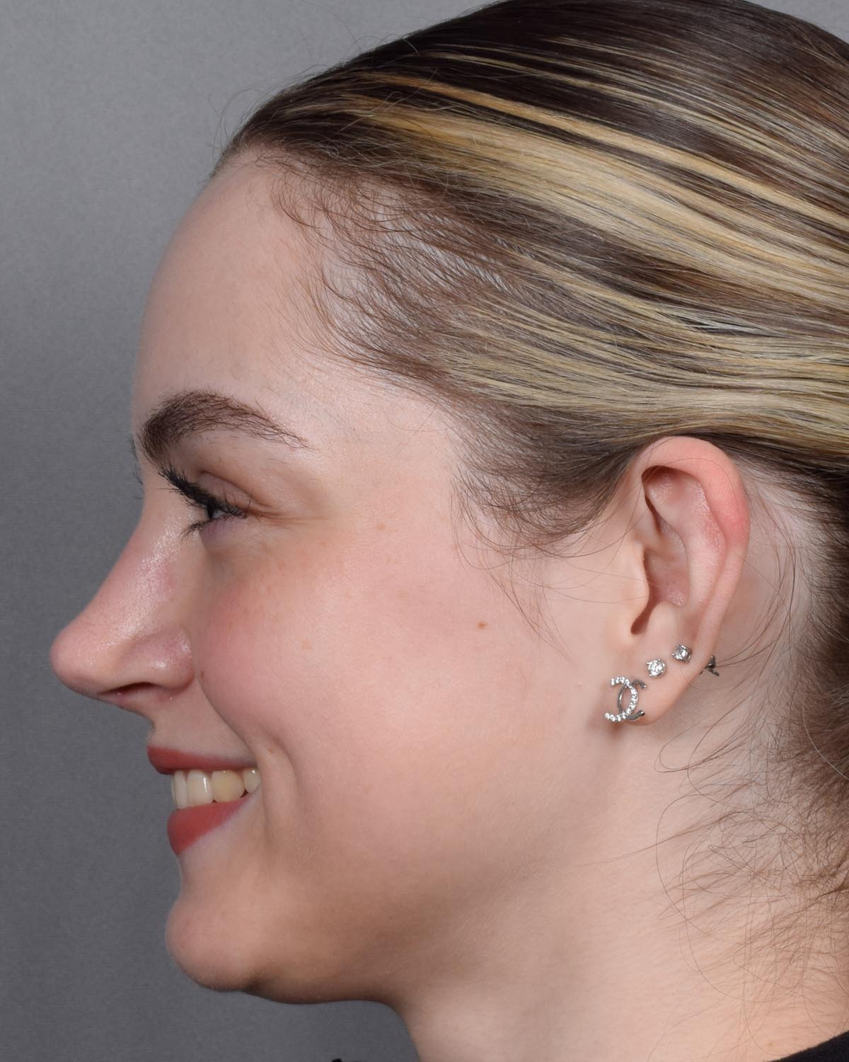 After Functional Rhinoplasty Profile Smiling - Vegas Facial Plastics, Mehdi Sina, MD