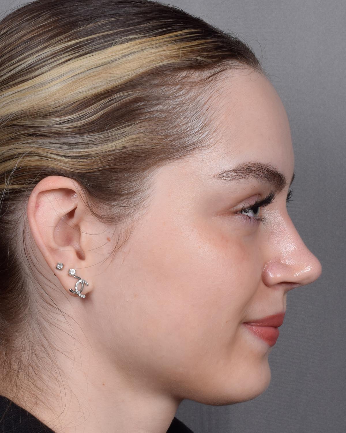 After Functional Rhinoplasty Profile - Vegas Facial Plastics, Mehdi Sina, MD