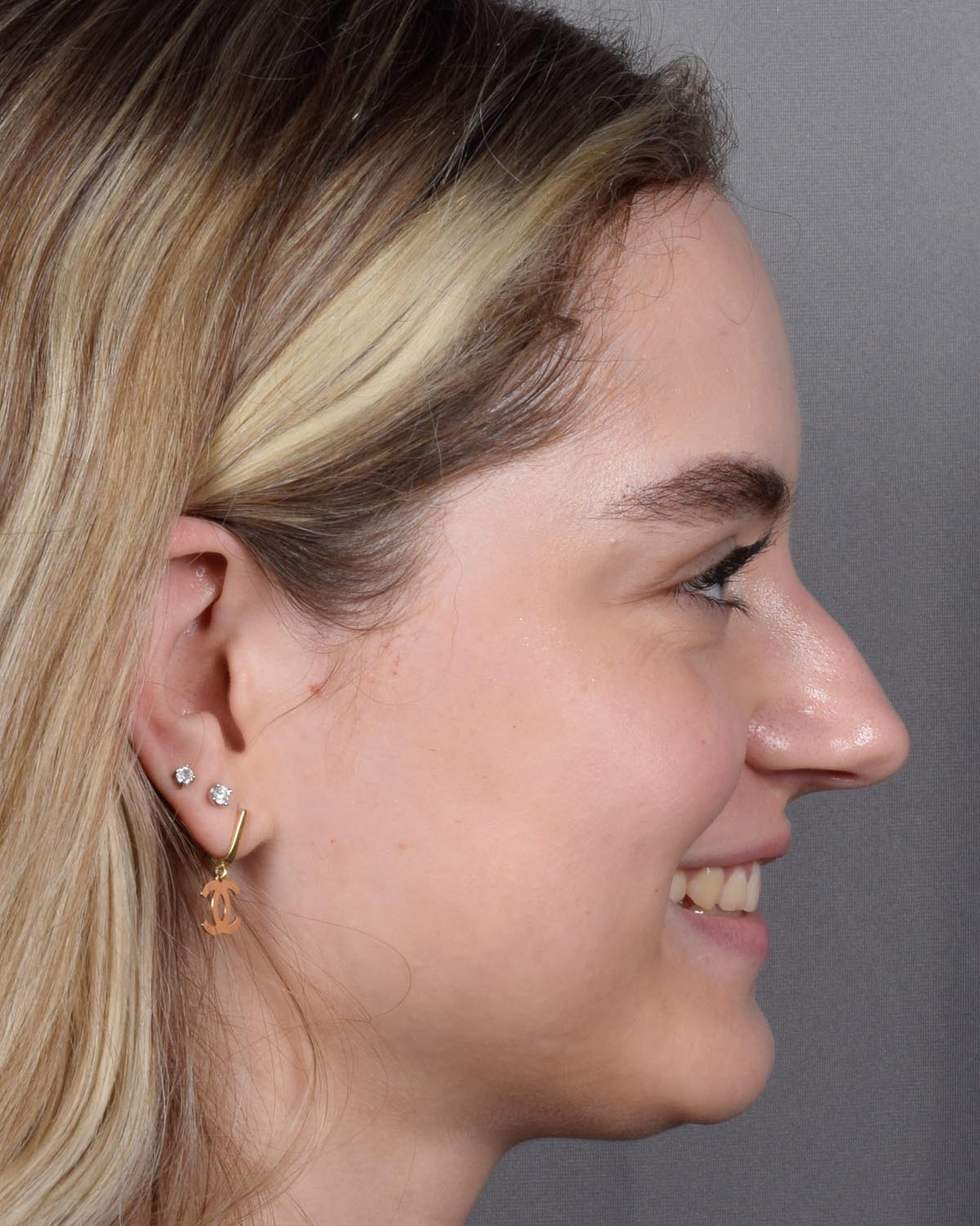 Before Functional Rhinoplasty Profile Smiling - Vegas Facial Plastics, Mehdi Sina, MD