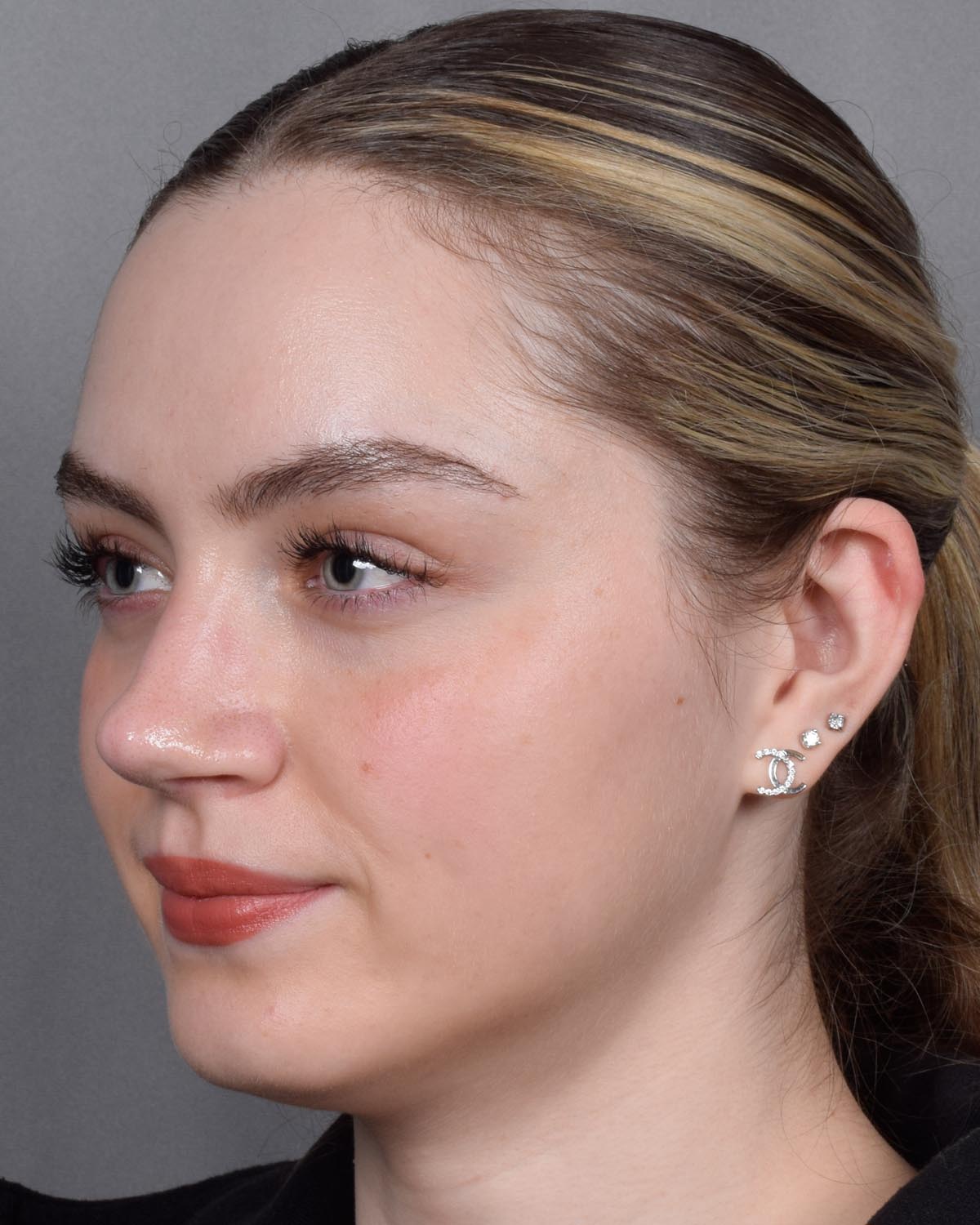 After Functional Rhinoplasty Oblique - Vegas Facial Plastics, Mehdi Sina, MD