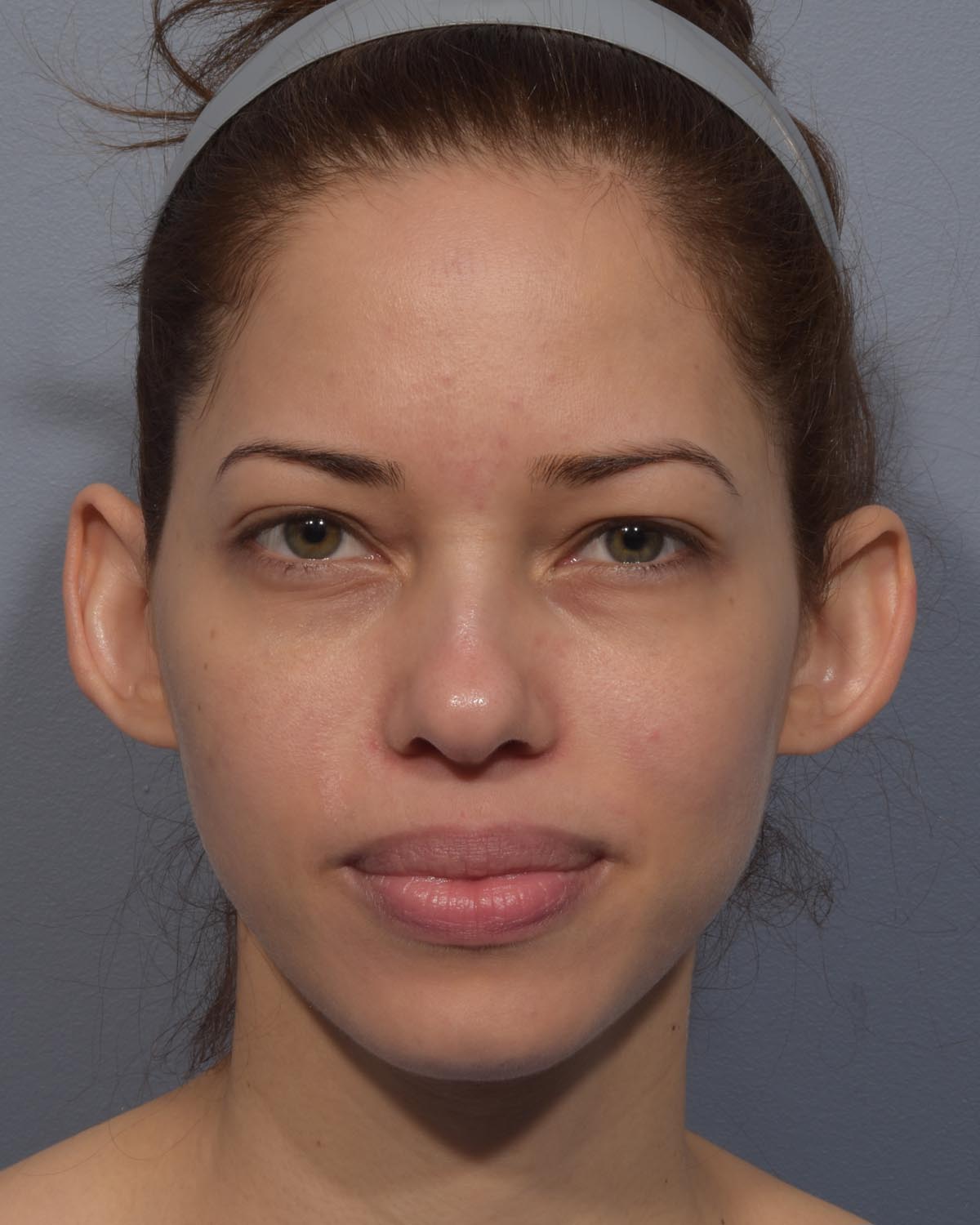 Before Otoplasty (Ear Surgery) - Vegas Facial Plastics, Mehdi Sina, MD