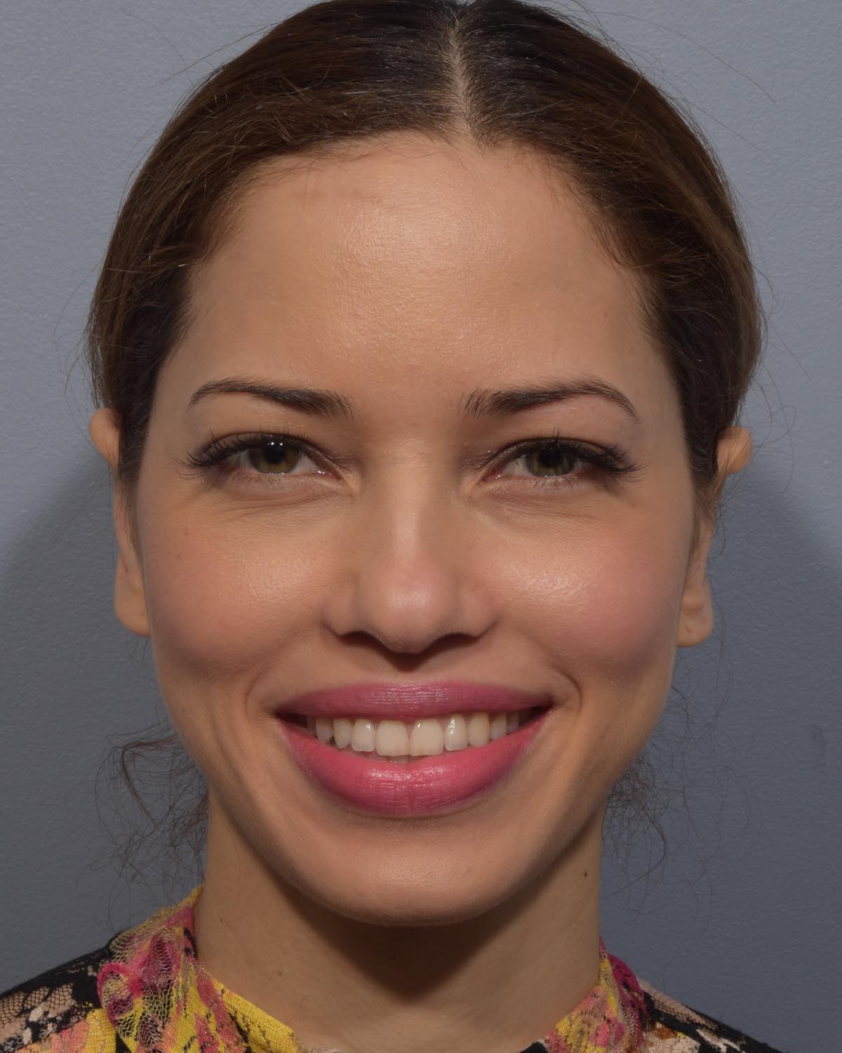 After Otoplasty (Ear Surgery) - Vegas Facial Plastics, Mehdi Sina, MD