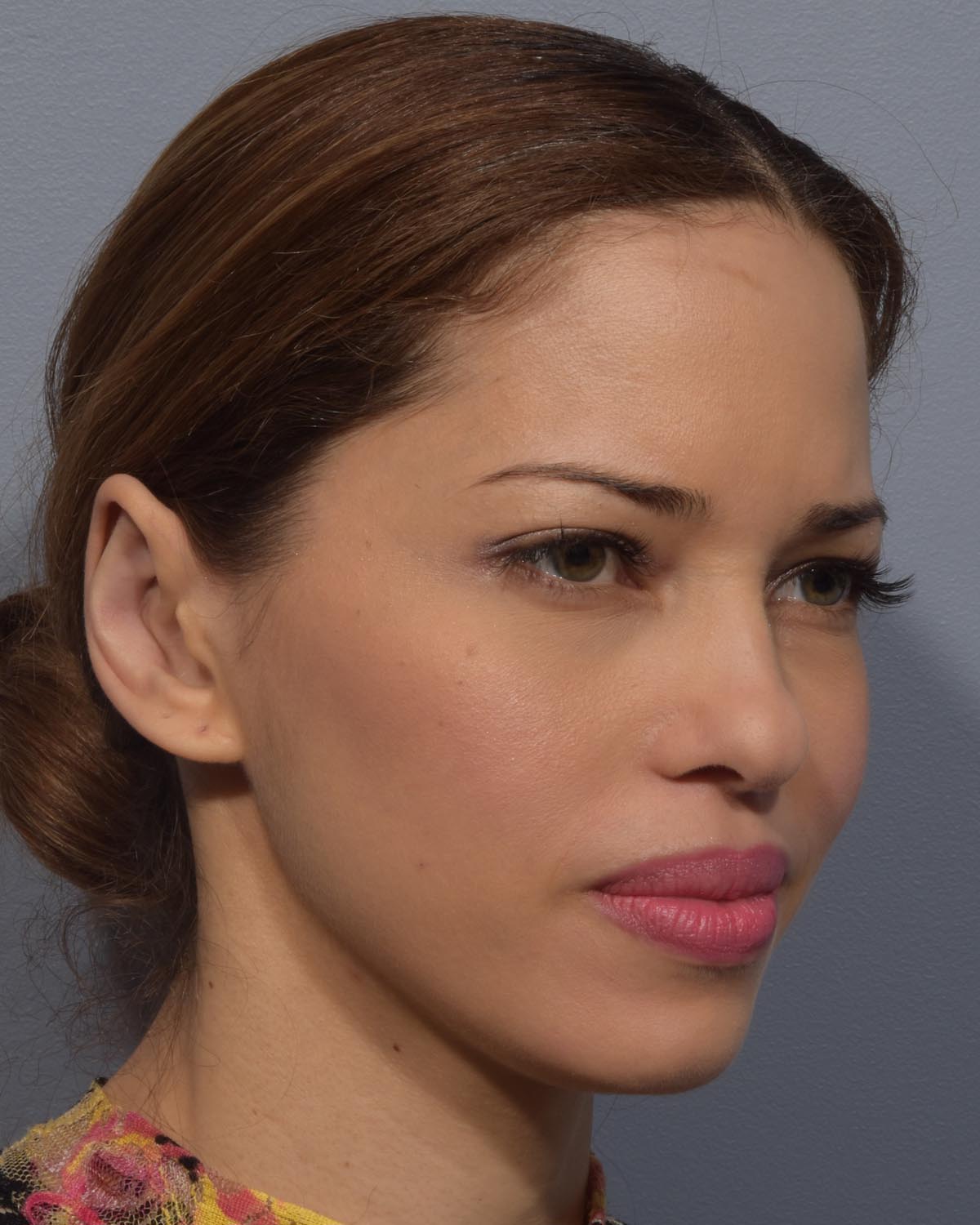 After Otoplasty (Ear Surgery) Oblique - Vegas Facial Plastics, Mehdi Sina, MD