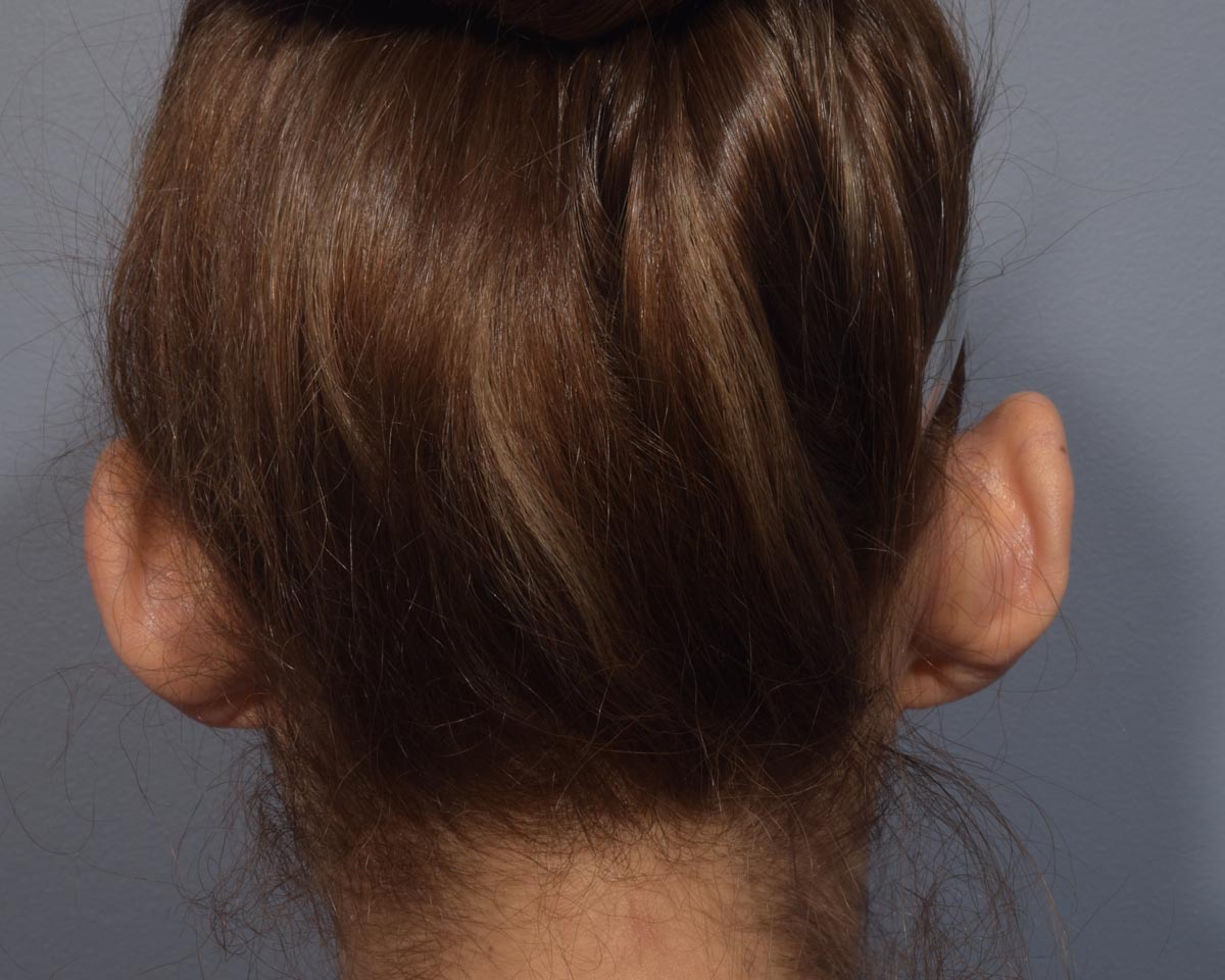 Before Otoplasty (Ear Surgery) Back View - Vegas Facial Plastics, Mehdi Sina, MD