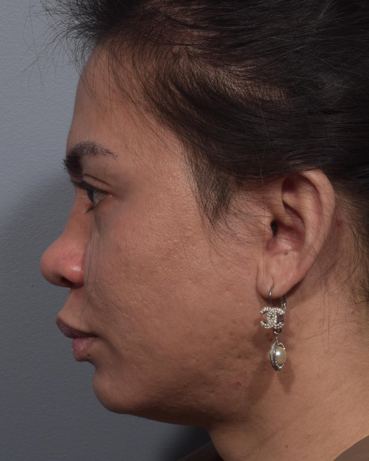 Before Rhinoplasty Profile - Vegas Facial Plastics, Mehdi Sina, MD