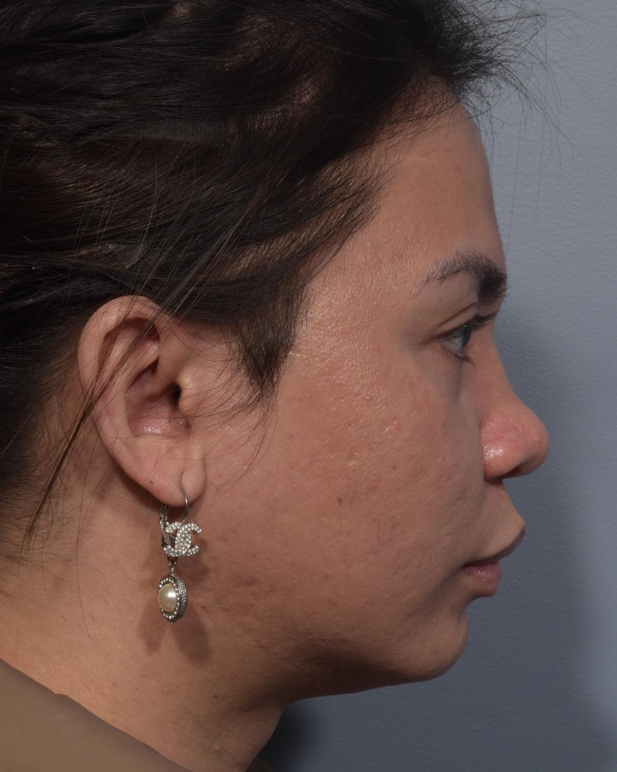 Before Rhinoplasty Profile - Vegas Facial Plastics, Mehdi Sina, MD
