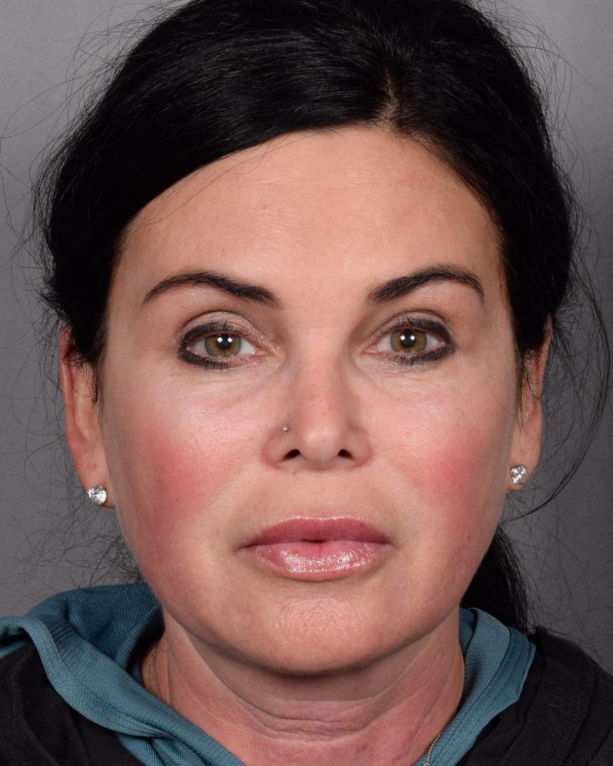 After Brow Lift - Vegas Facial Plastics, Mehdi Sina, MD