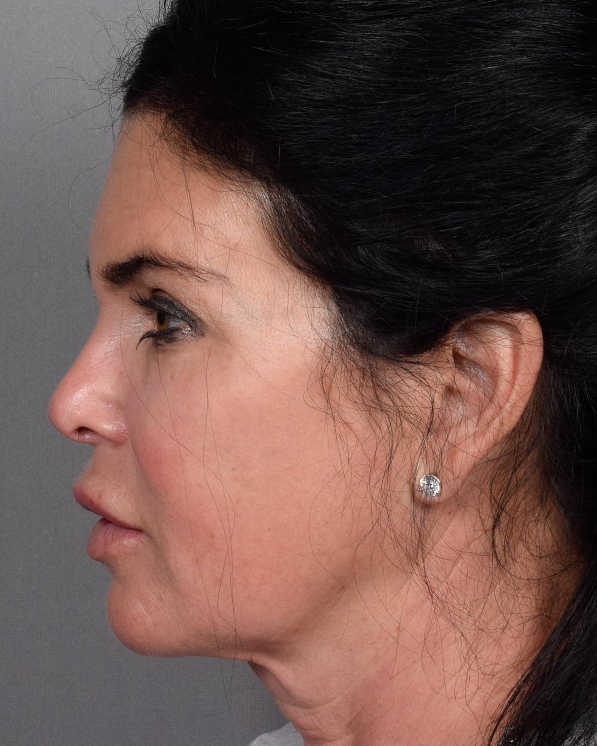 Before Brow Lift Profile - Vegas Facial Plastics, Mehdi Sina, MD