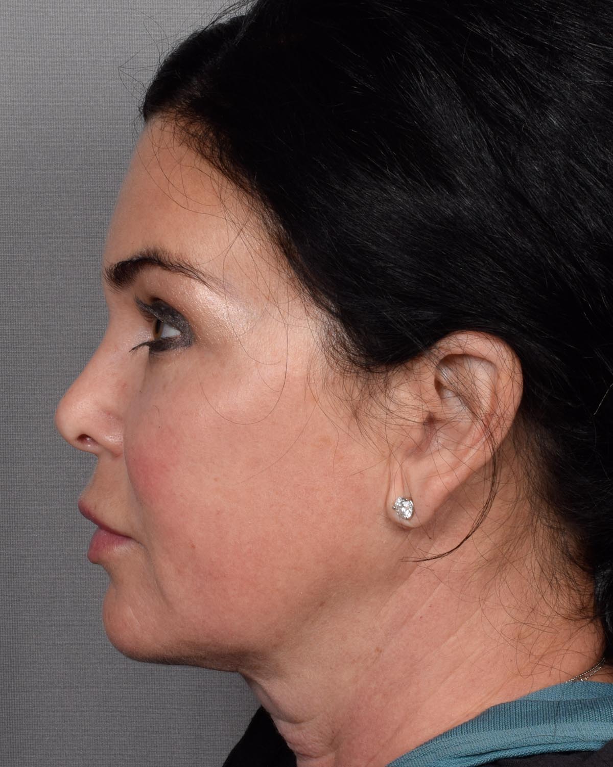 After Brow Lift Profile - Vegas Facial Plastics, Mehdi Sina, MD