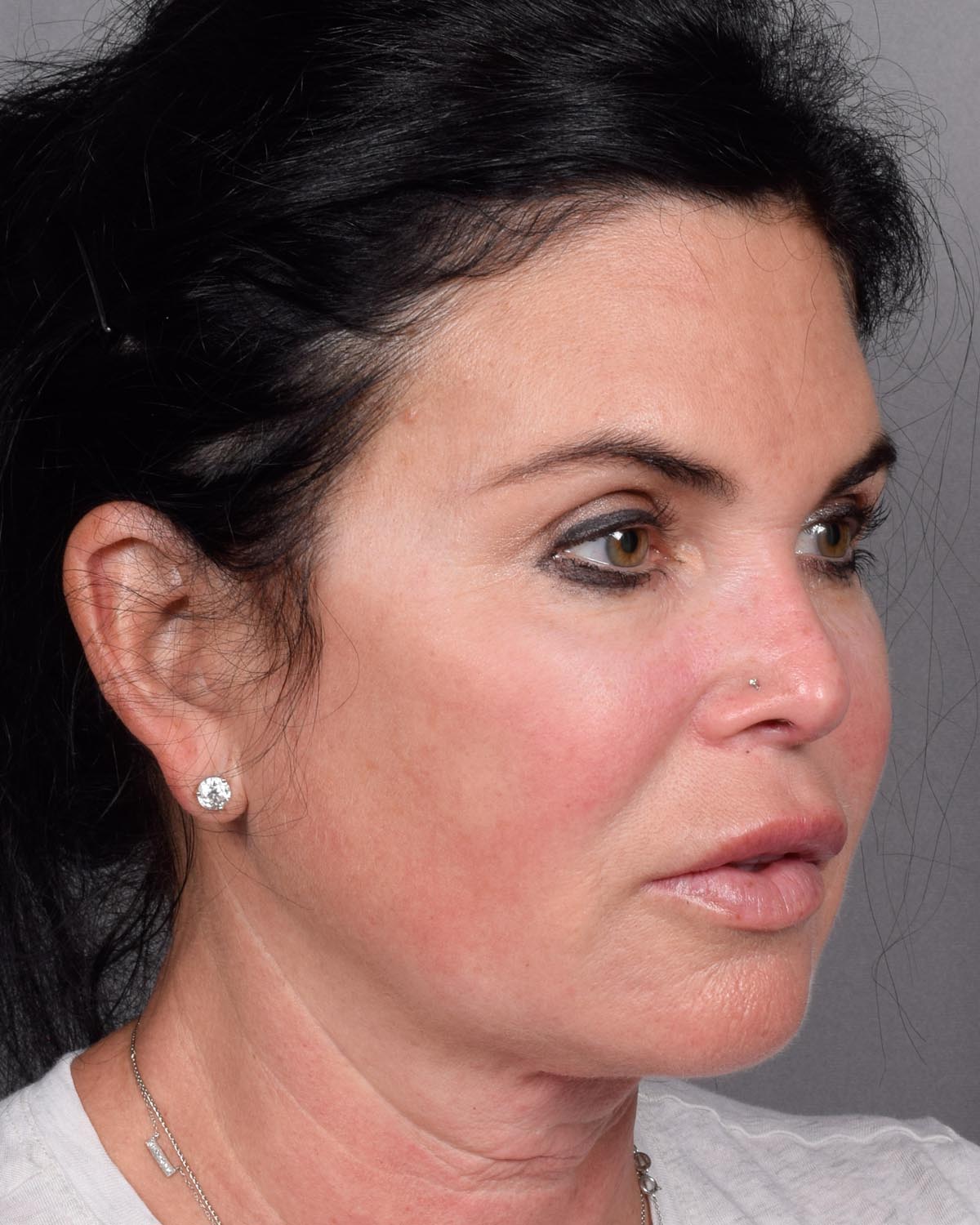 Before Brow Lift Oblique - Vegas Facial Plastics, Mehdi Sina, MD