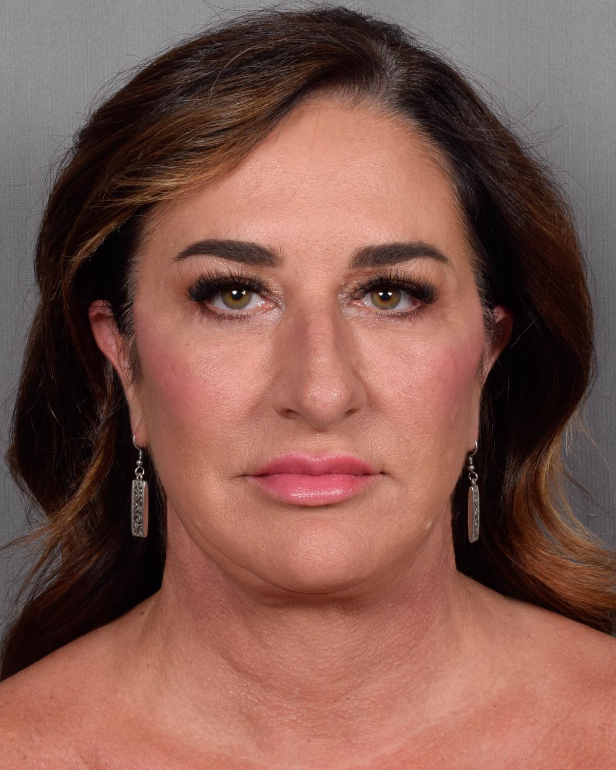 After Blepharoplasty, facelift and neck lift, full face Laser resurfacing with CO2