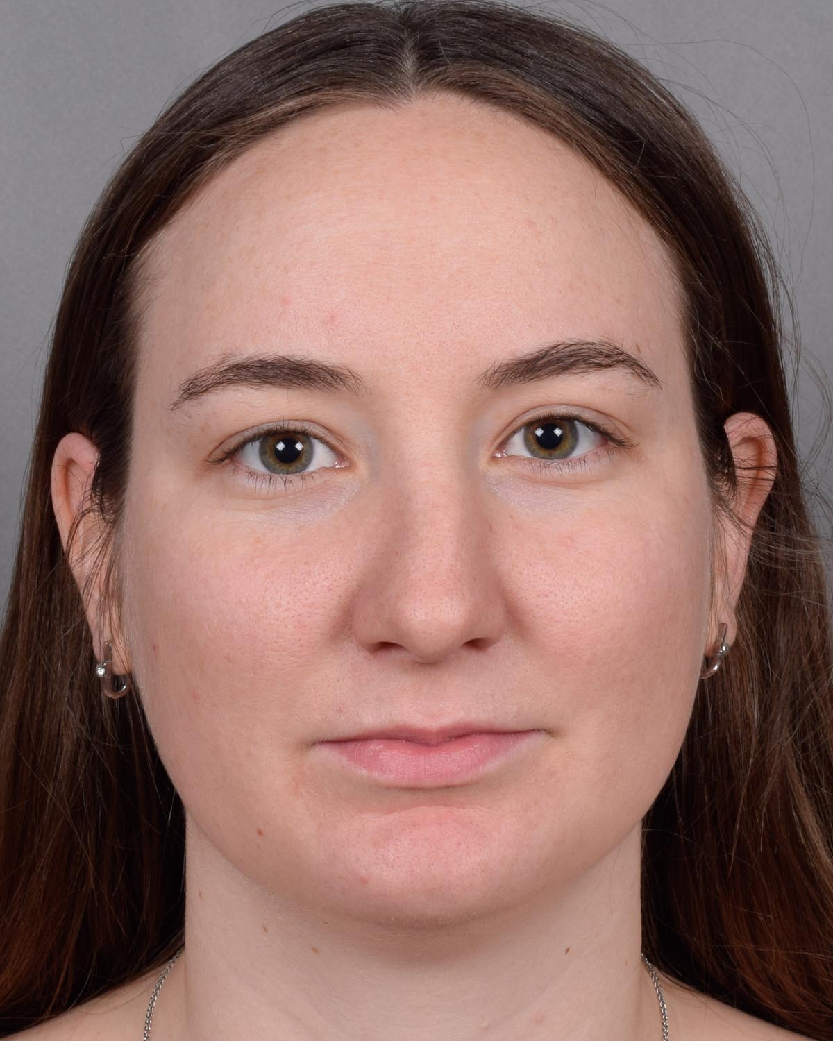 Before Functional Rhinoplasty - Vegas Facial Plastics, Mehdi Sina, MD