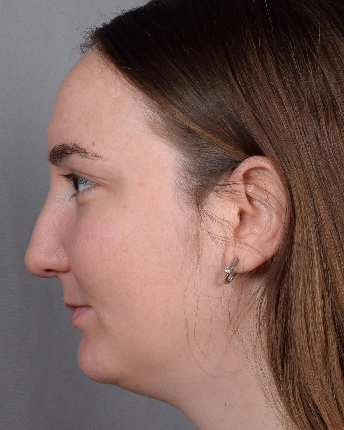 Before Functional Rhinoplasty Profile - Vegas Facial Plastics, Mehdi Sina, MD