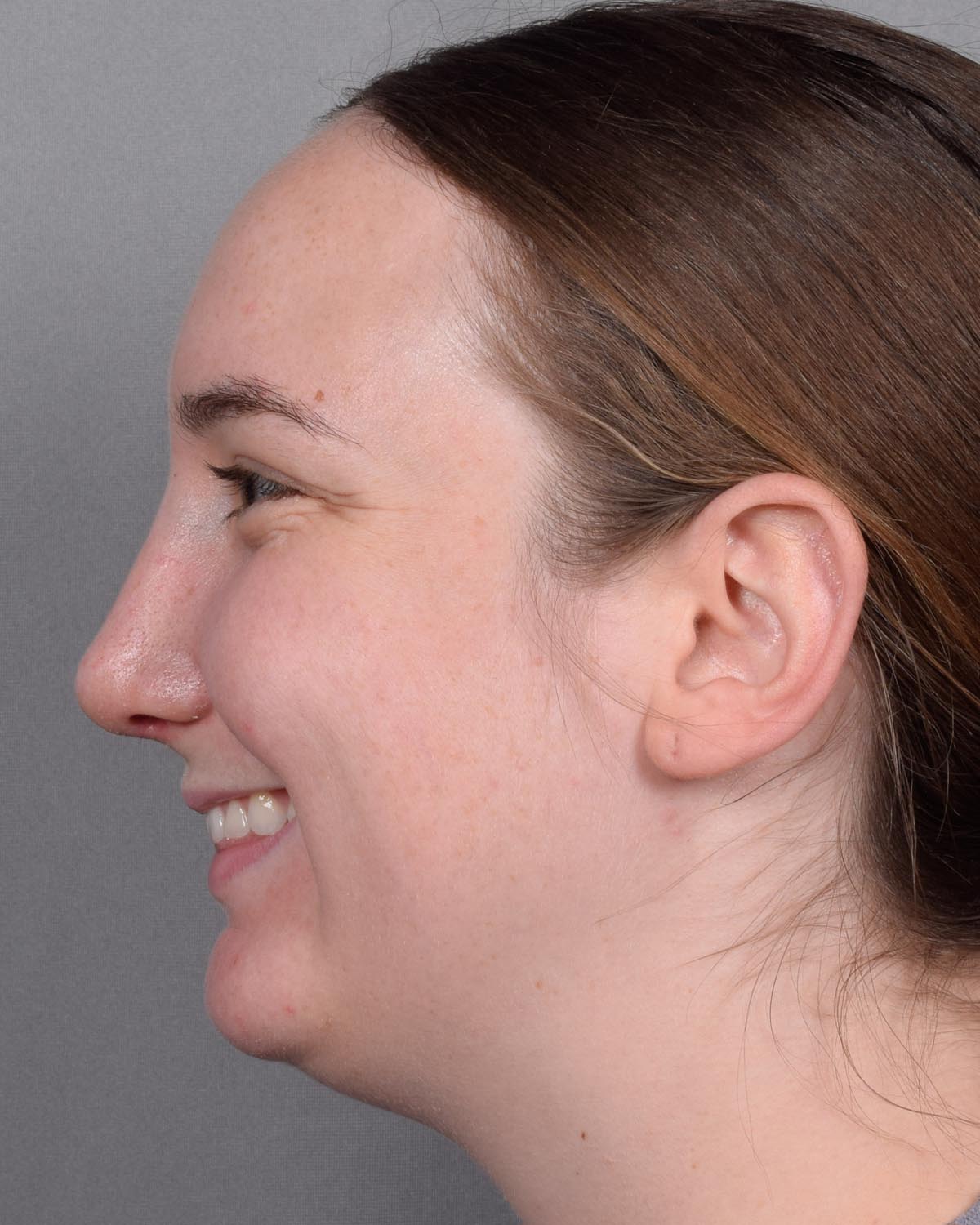 After Functional Rhinoplasty Profile Smiling - Vegas Facial Plastics, Mehdi Sina, MD