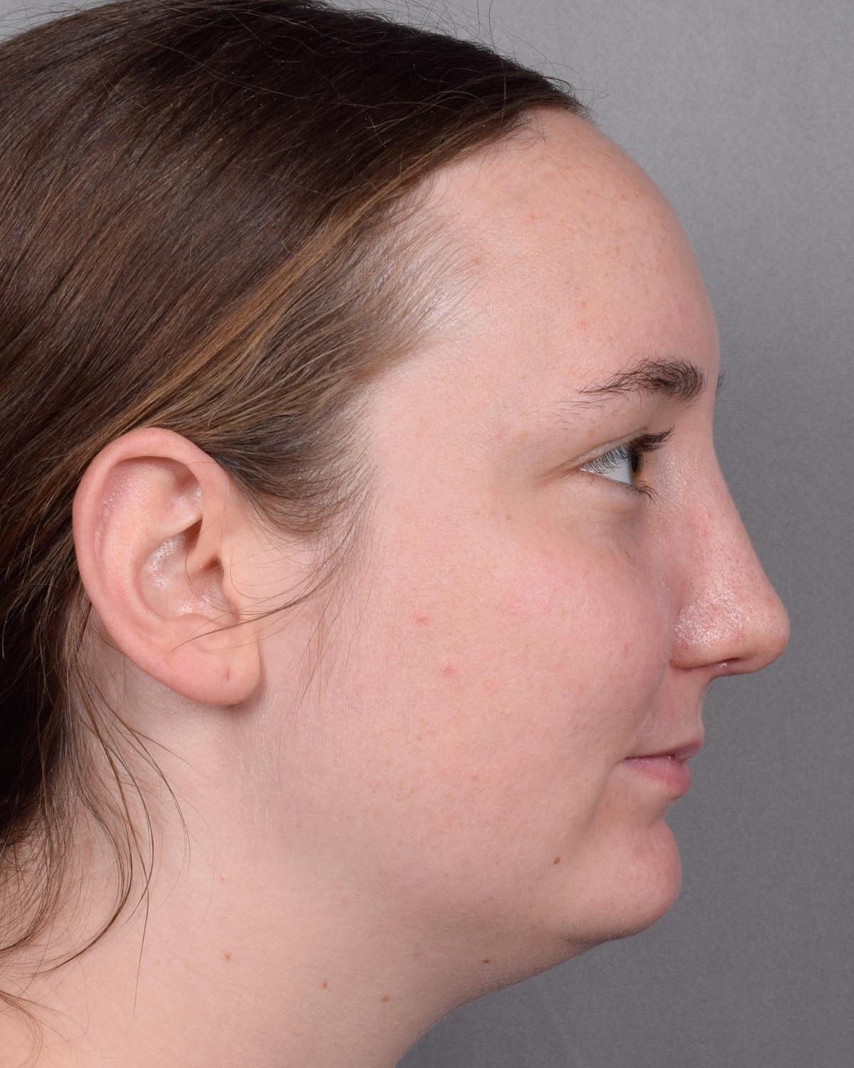 After Functional Rhinoplasty Profile - Vegas Facial Plastics, Mehdi Sina, MD