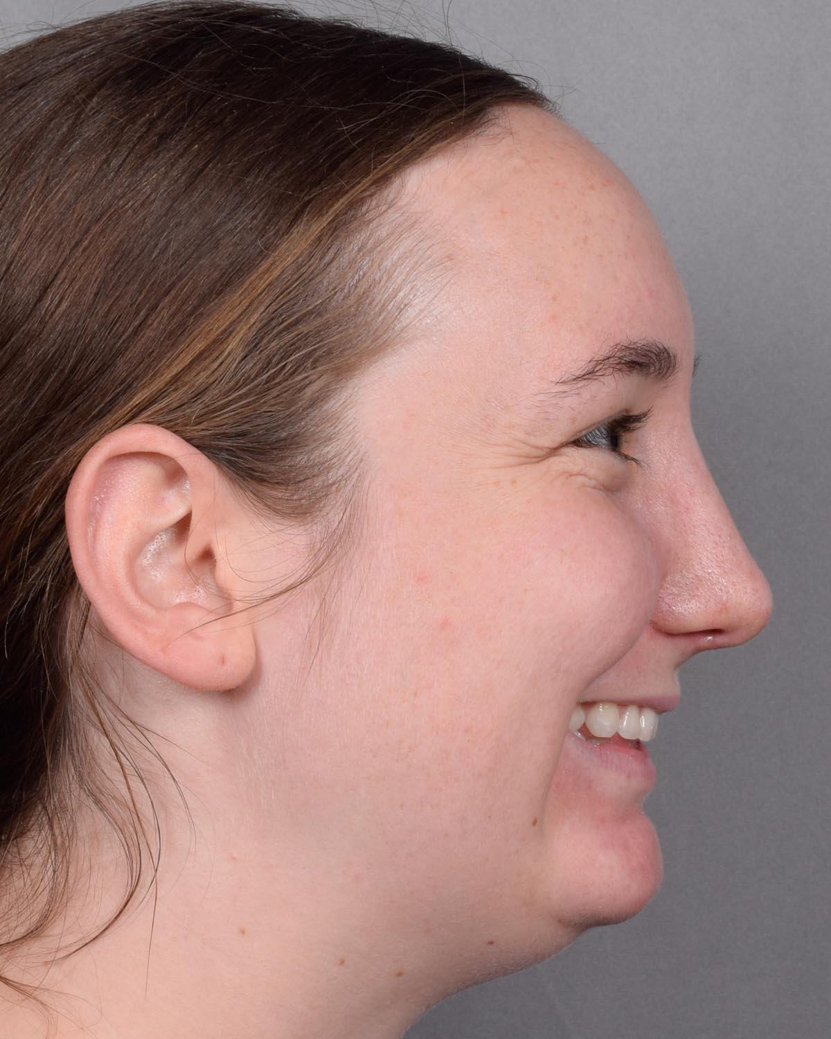 After Functional Rhinoplasty Profile Smiling - Vegas Facial Plastics, Mehdi Sina, MD