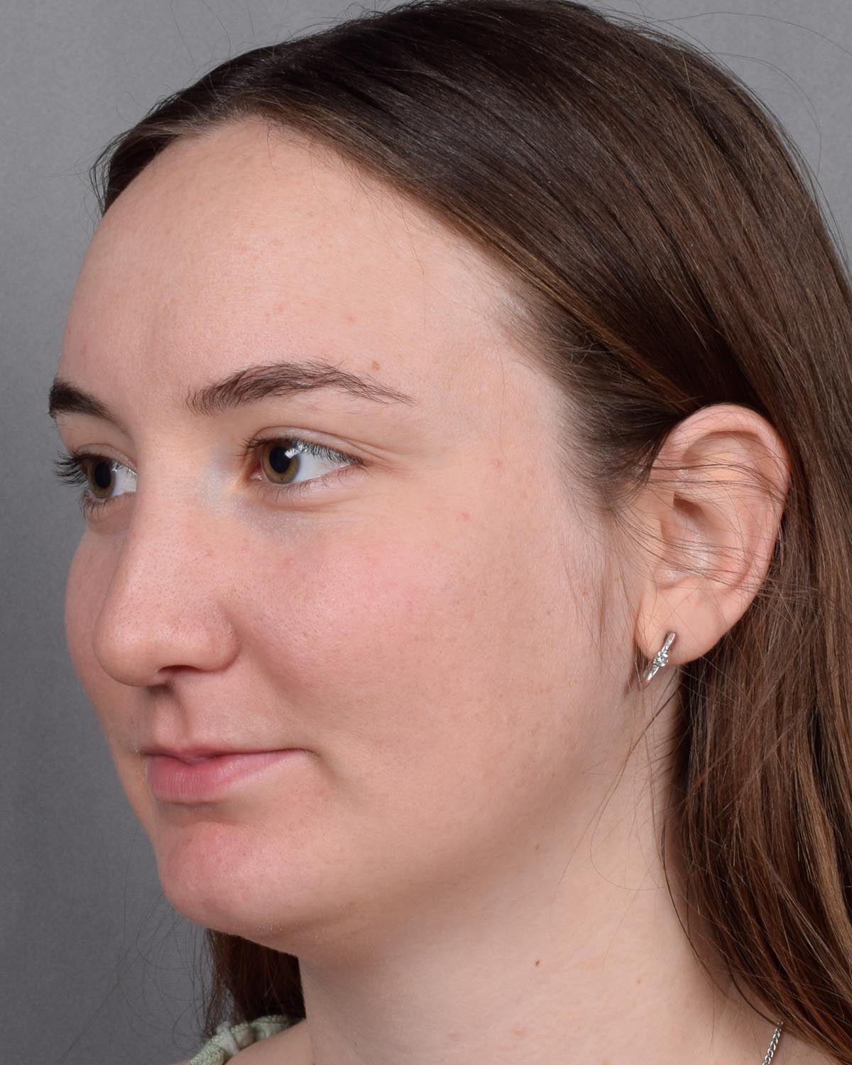 Before Functional Rhinoplasty Oblique - Vegas Facial Plastics, Mehdi Sina, MD